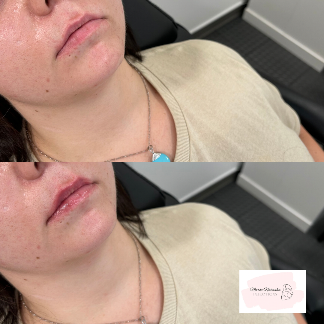 1/4 syringe to top lip