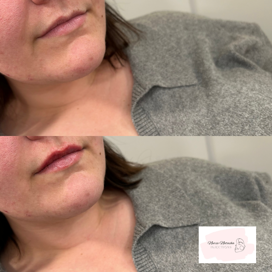 1/4 syringe to top lip