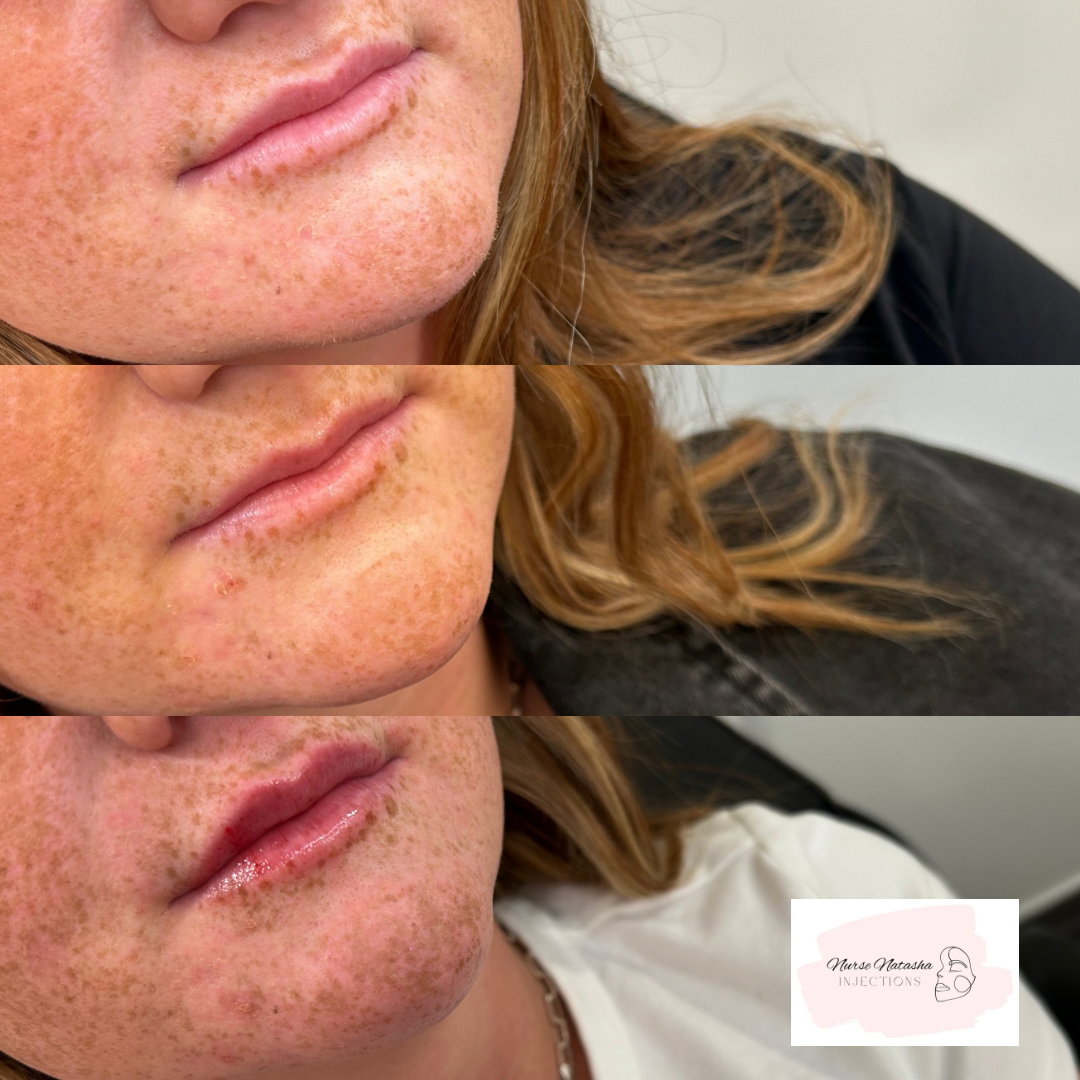 Top photo previous migrated lip filler not done by me, middle photo is after dissolving and bottom photo is after half syringe of lip filler