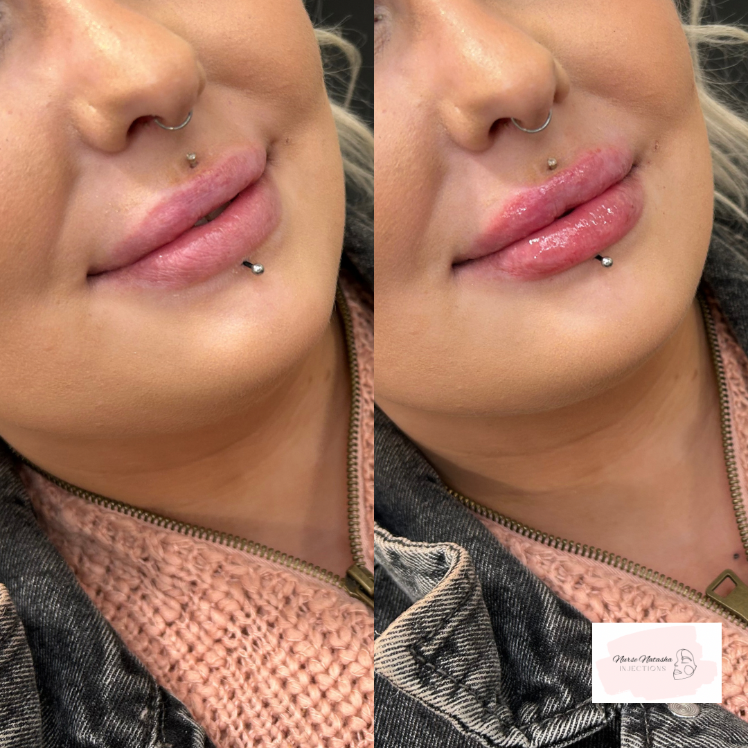 Left 1/2 syringe healed, right 1/2 syringe added