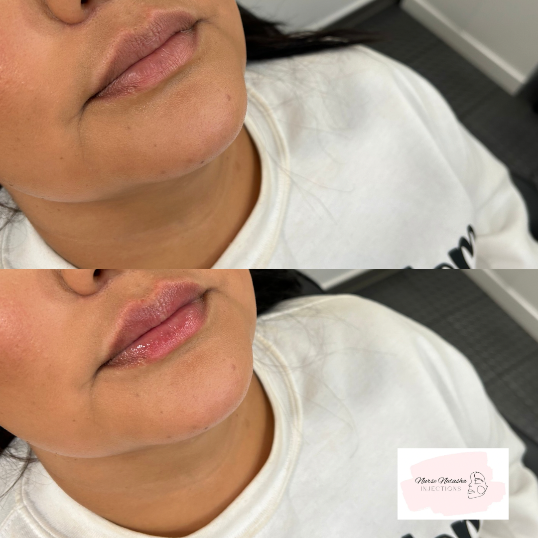 Top photo 1/2 syringe healed, bottom photo another 1/2 syringe added
