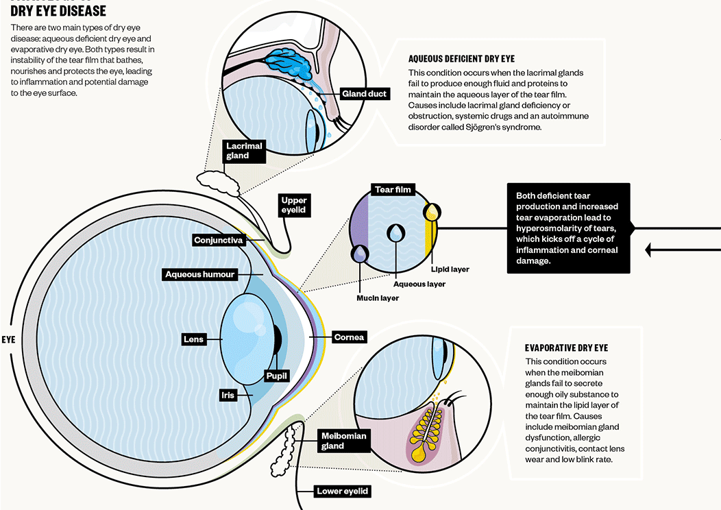 Editorial feature studying dry eye disease for RPS.