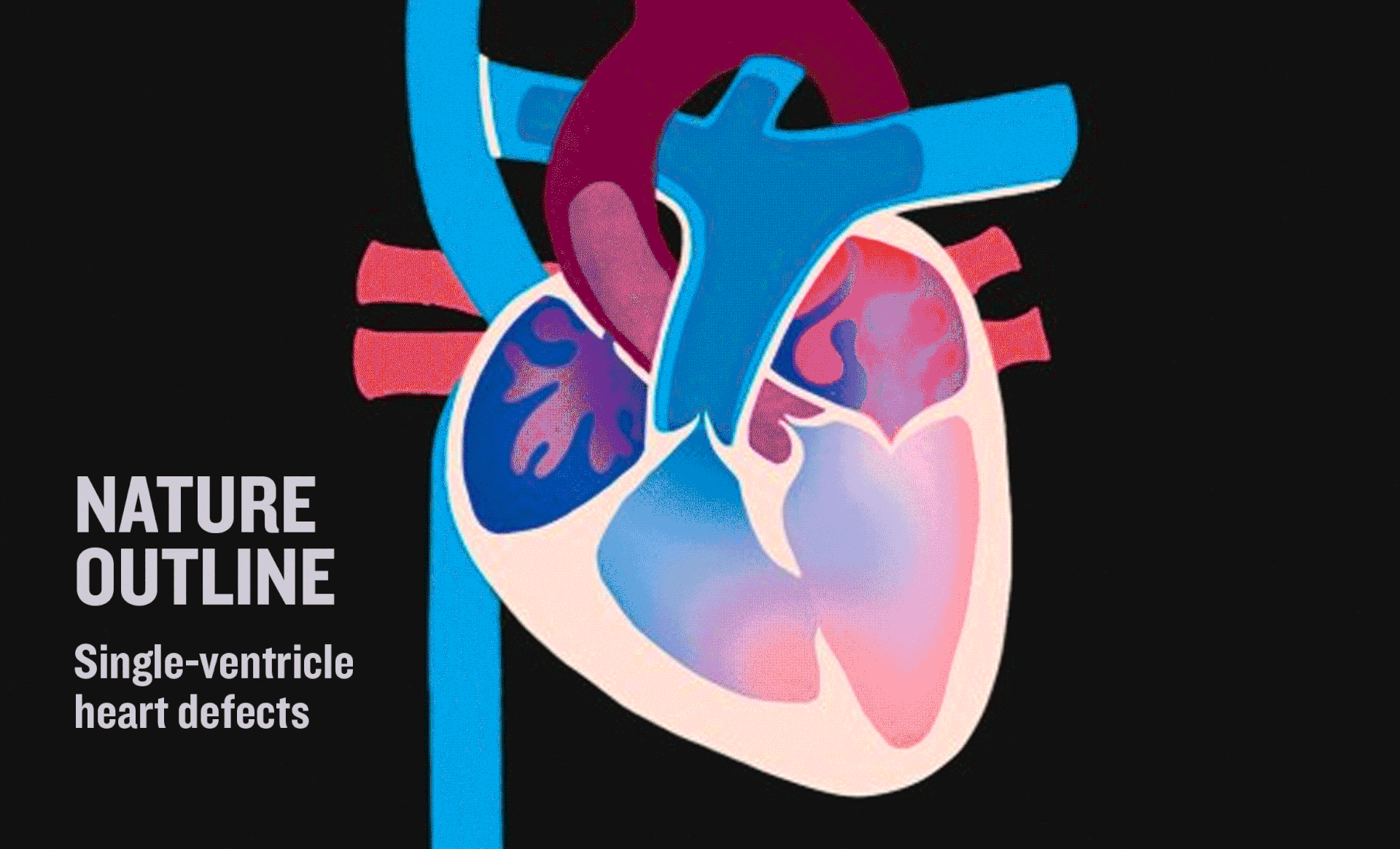 "101" article on single heart defects, for Nature.
