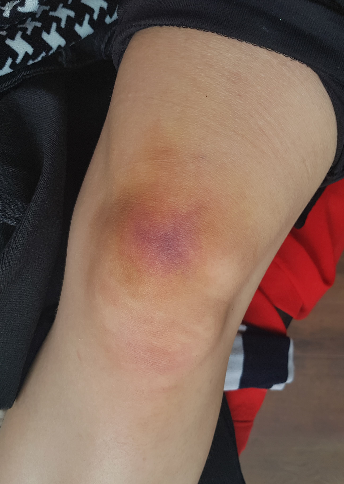 3-5 days old bruise (20yr old female)