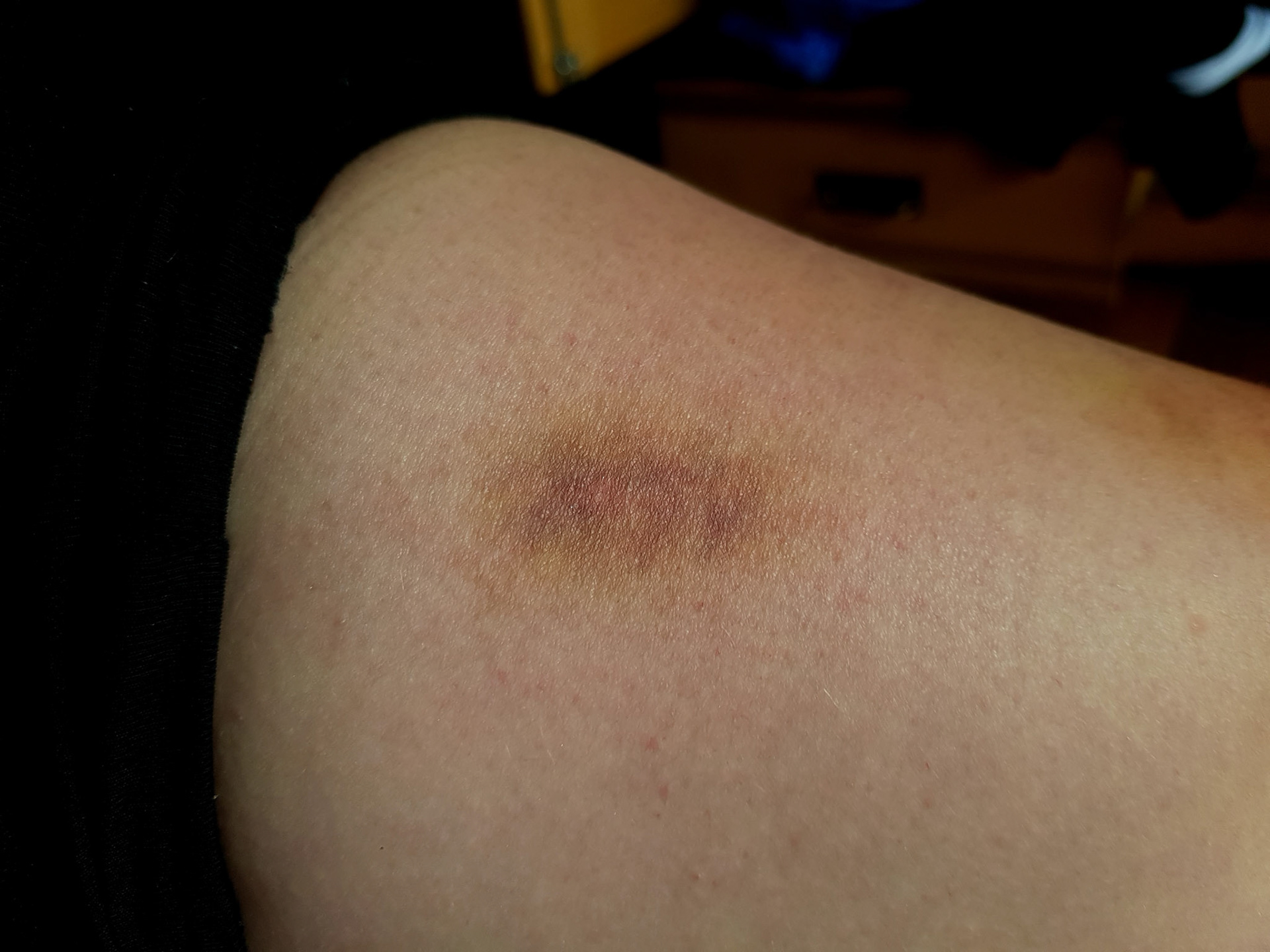 6-8 days old bruise (20yr old female)