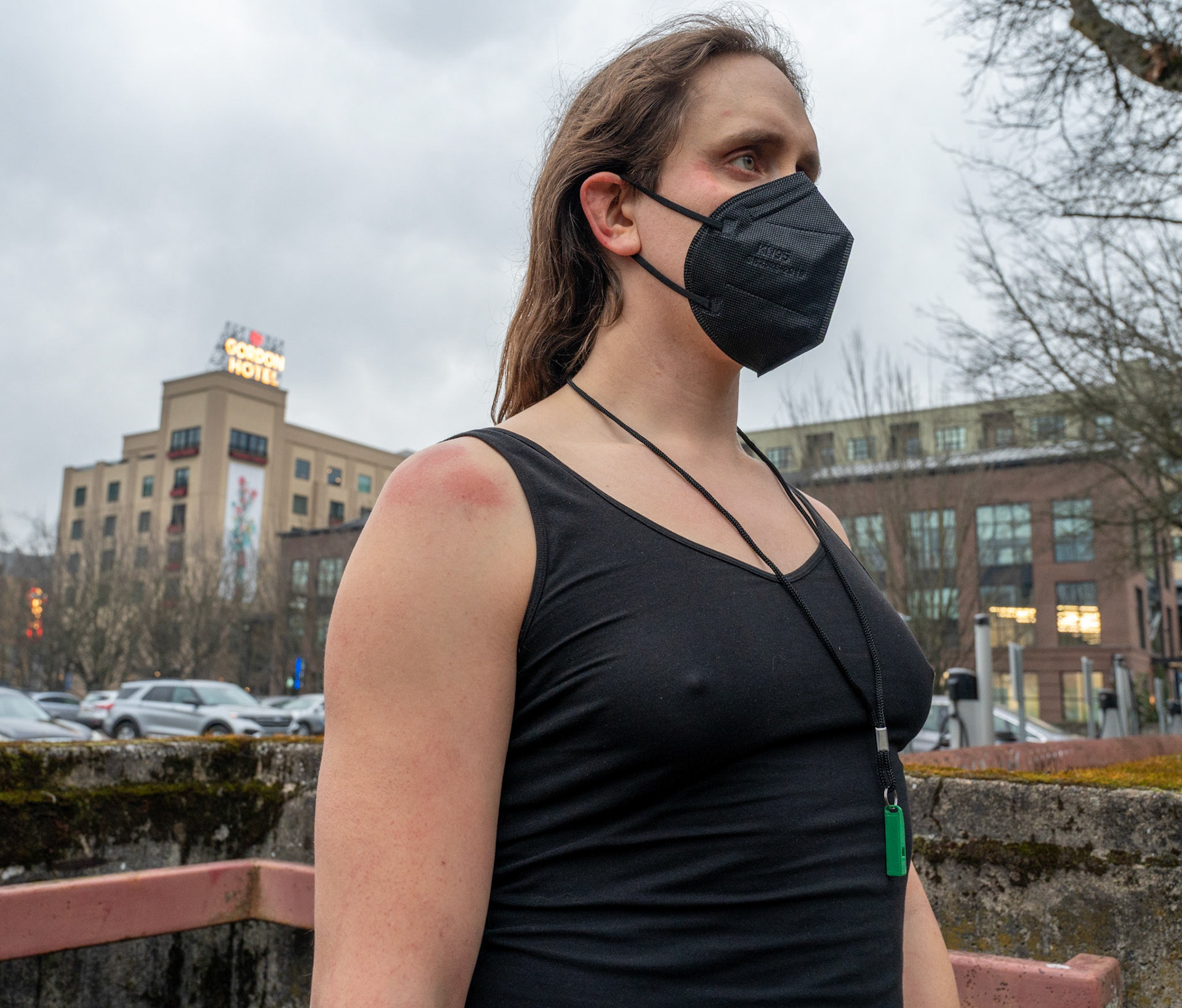 Anna Lardner was the first person detained by DHS Jan. 27; here, she shows how agents inside roughed her up enough to leave marks.