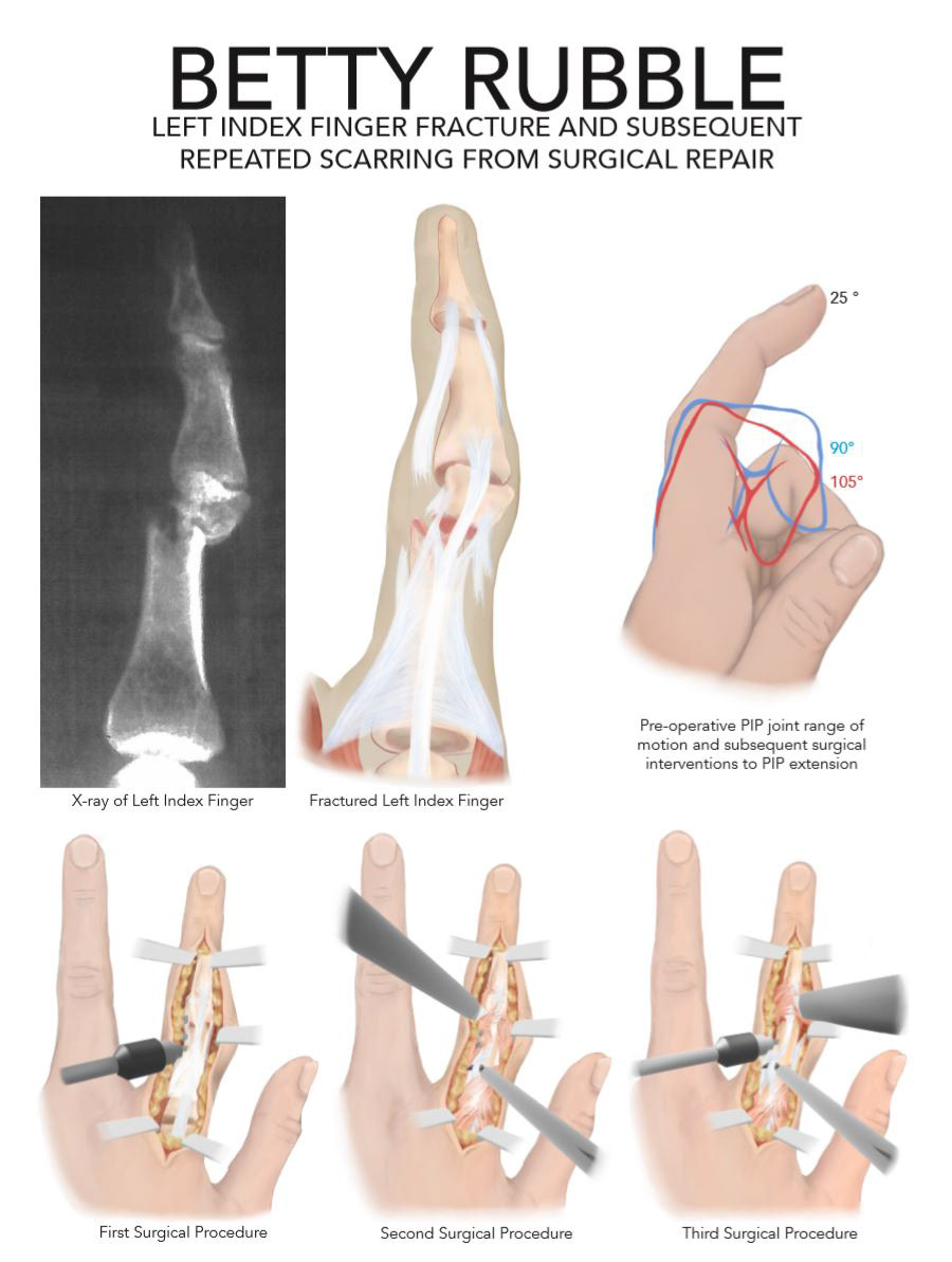 Medical Legal Case of Finger Injury - Examined Medical files to create a Medical Legal piece to support patient, Used Adobe Photoshop and InDesign - Fall 2018
