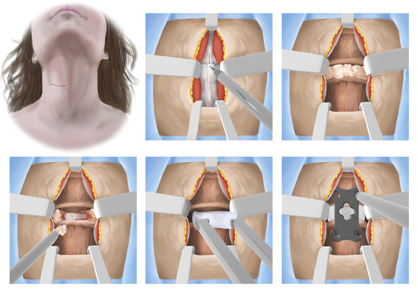 Anterior Cervical Discectomy  and Fusion - Observed in Surgery, Sketched, Finished in Adobe Photoshop - Fall 2018