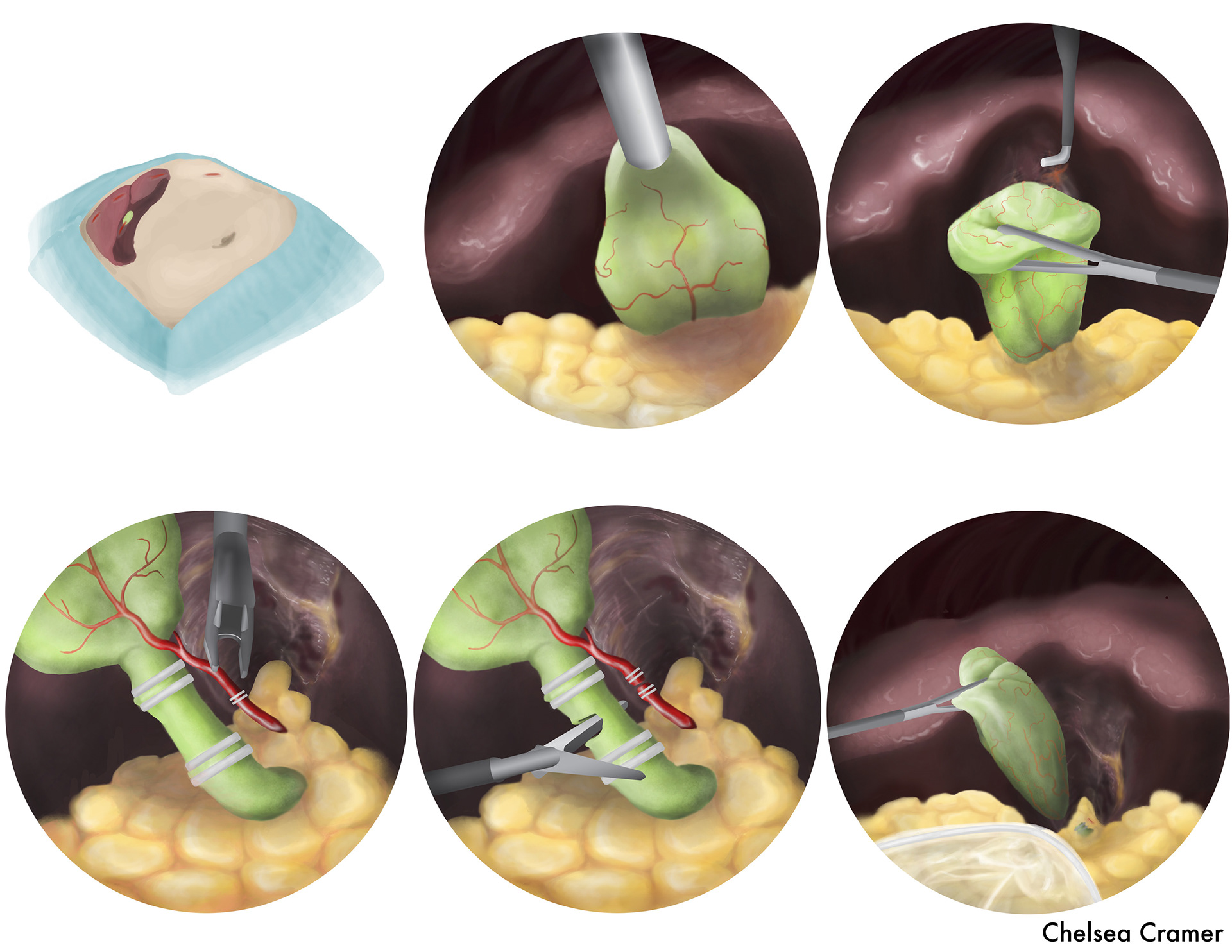 Laparoscopic Gallbladder Removal - Observed in Surgery, sketched, Finished in Adobe Photoshop - Fall 2018