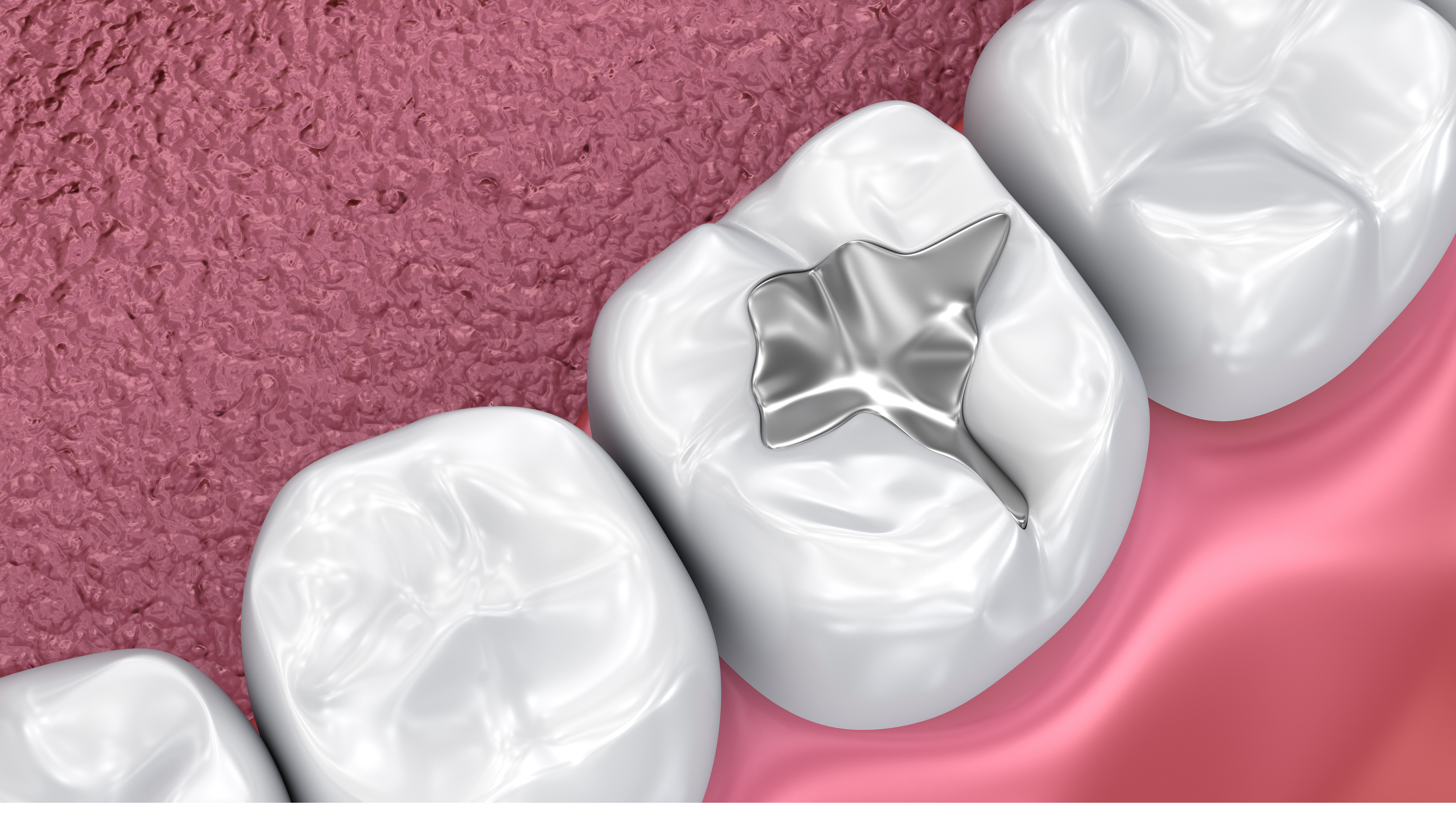 Dental fillings procedure at The Dental Lounge in Indore, Madhya Pradesh, India, expertly performed by Dr. Nidhi Vyas. Composite resin material perfectly matched to natural tooth color for a seamless restoration, ensuring a durable and aesthetically pleasing repair for cavities and minor tooth damage.