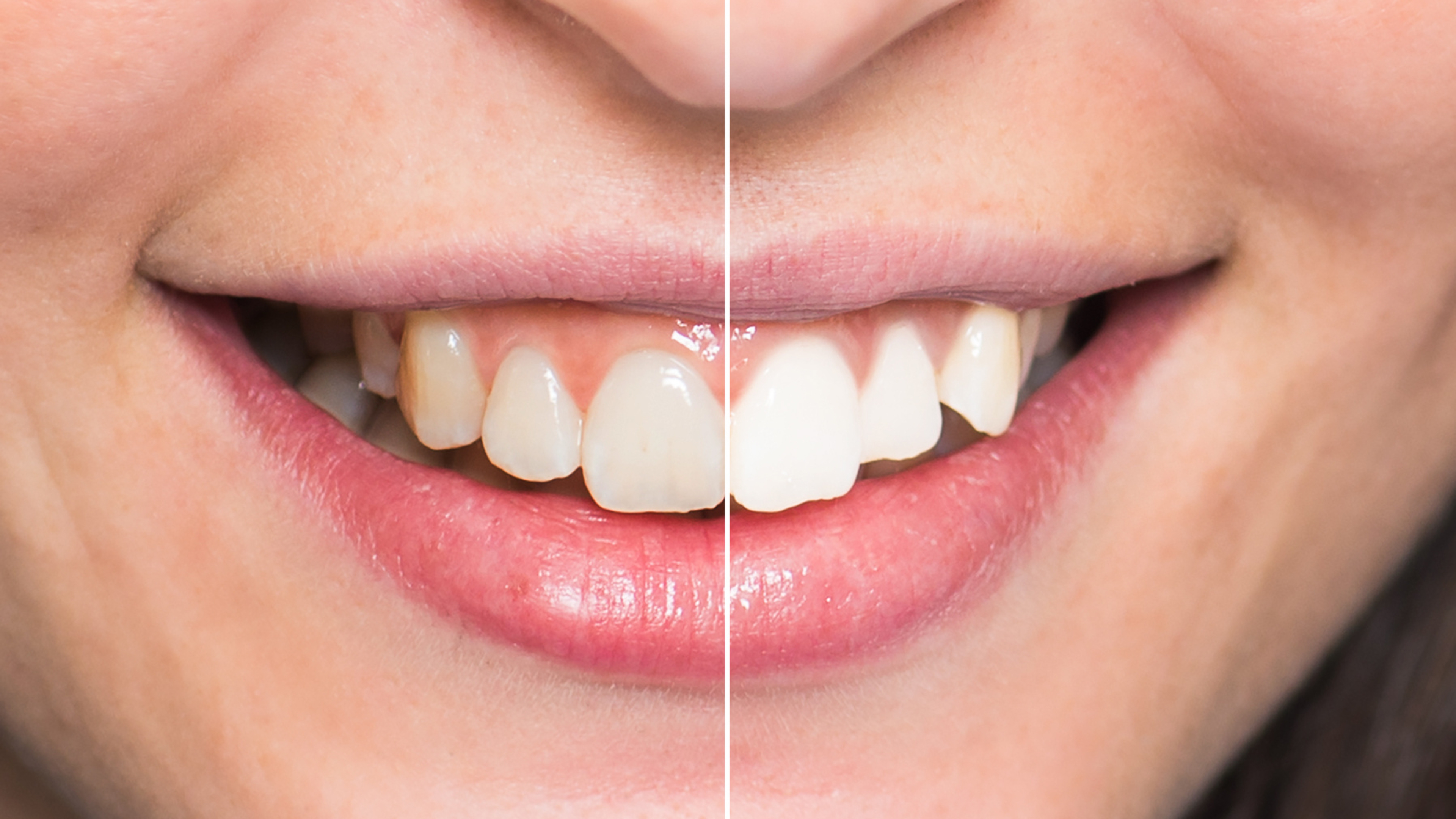 Before and after teeth whitening treatment at The Dental Lounge in Indore, Madhya Pradesh, India, showcasing the expert dental services provided by Dr. Nidhi Vyas. The image highlights the significant improvement in tooth brightness and color, demonstrating the effectiveness of professional whitening procedures.