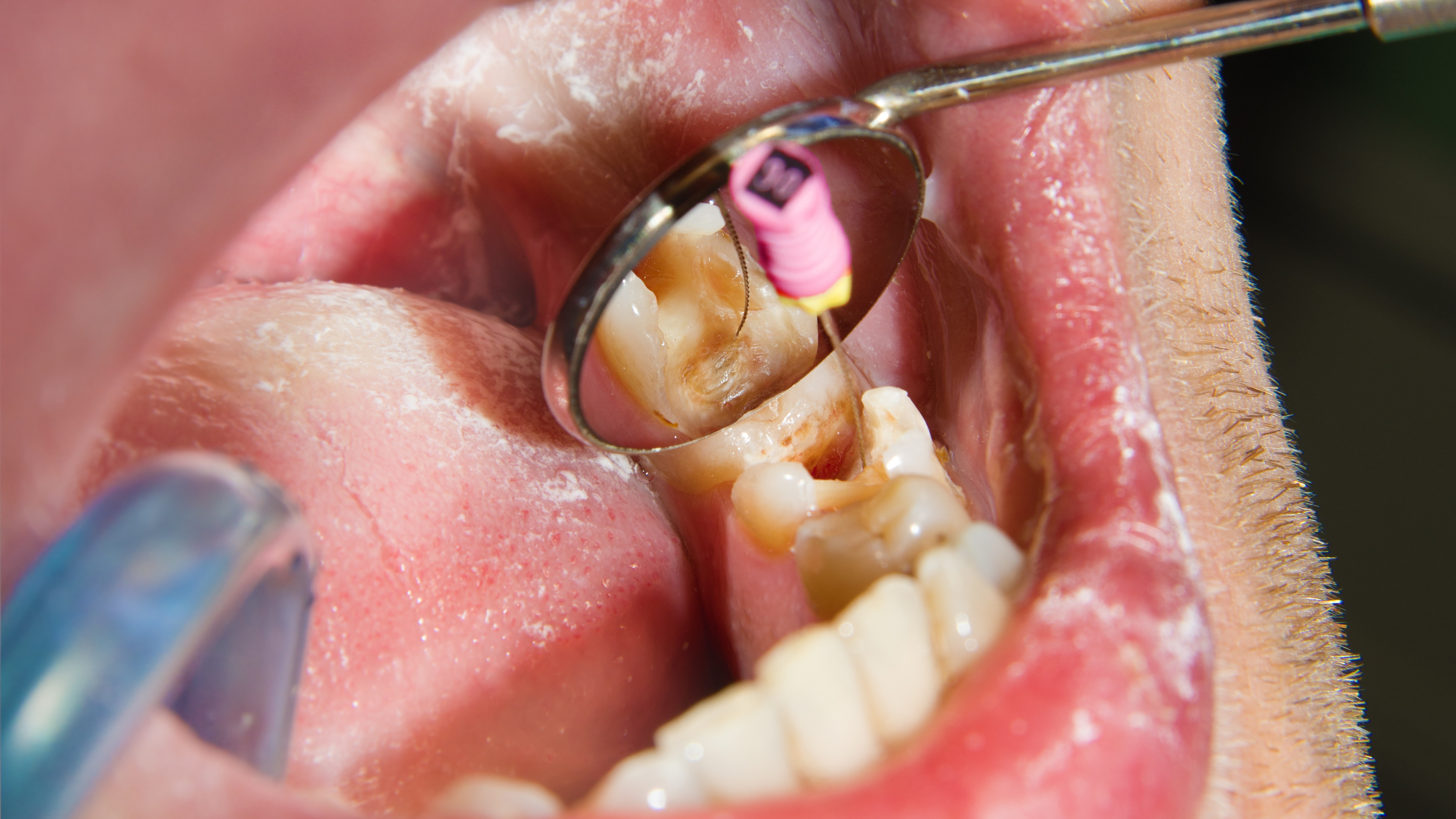 Root Canal Therapy procedure at The Dental Lounge in Indore, Madhya Pradesh, India, expertly performed by Dr. Nidhi Vyas. This image showcases the state-of-the-art dental technology and gentle care approach used to save a damaged tooth, ensuring a comfortable and effective treatment experience for patients.