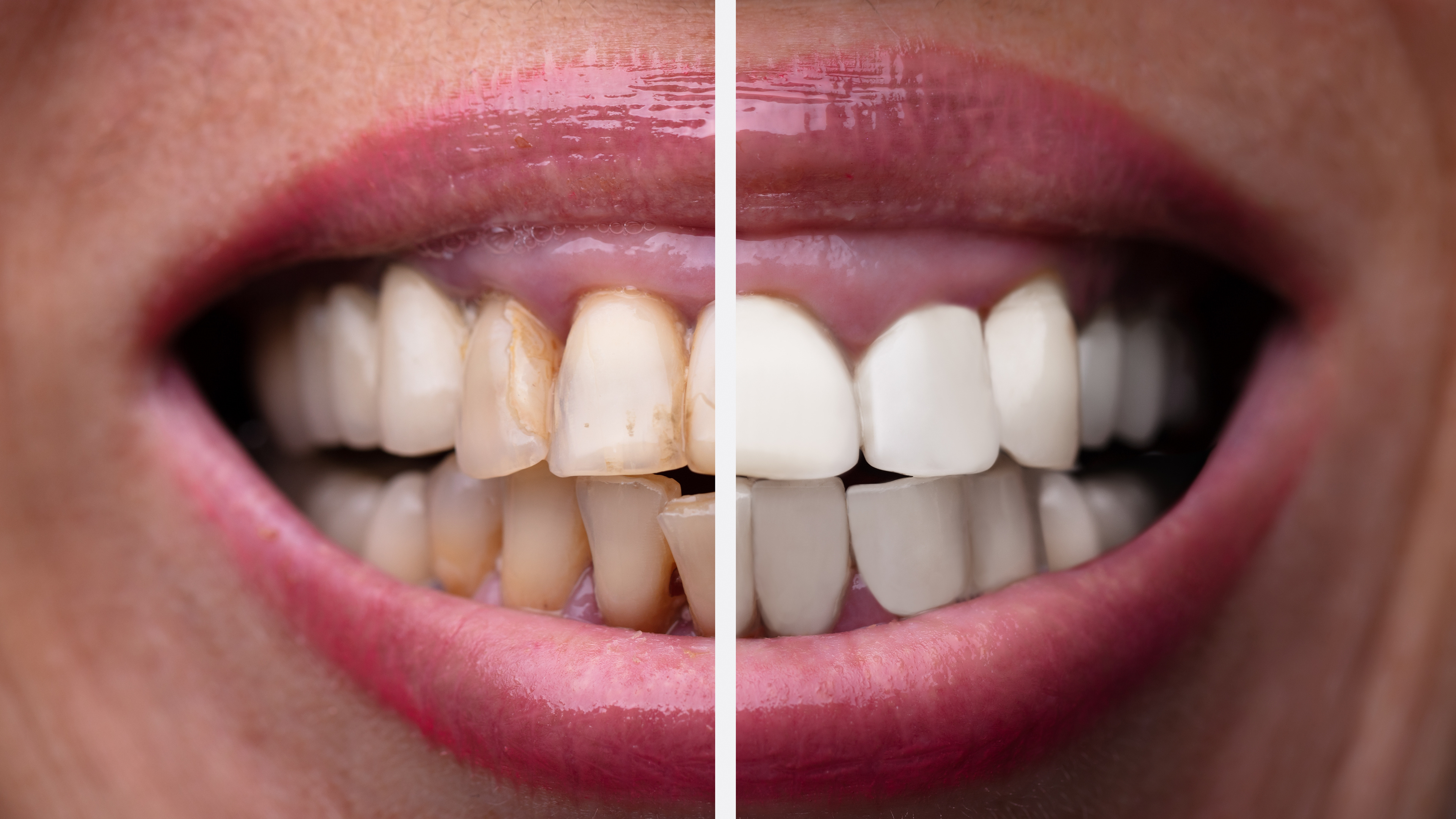 Before and after teeth whitening transformation at The Dental Lounge in Indore, Madhya Pradesh, India, showcasing the expertise of dentist Dr. Nidhi Vyas. The image captures a remarkable difference, with the left side displaying discolored, stained teeth, and the right side revealing a bright, white smile achieved through professional whitening treatment.