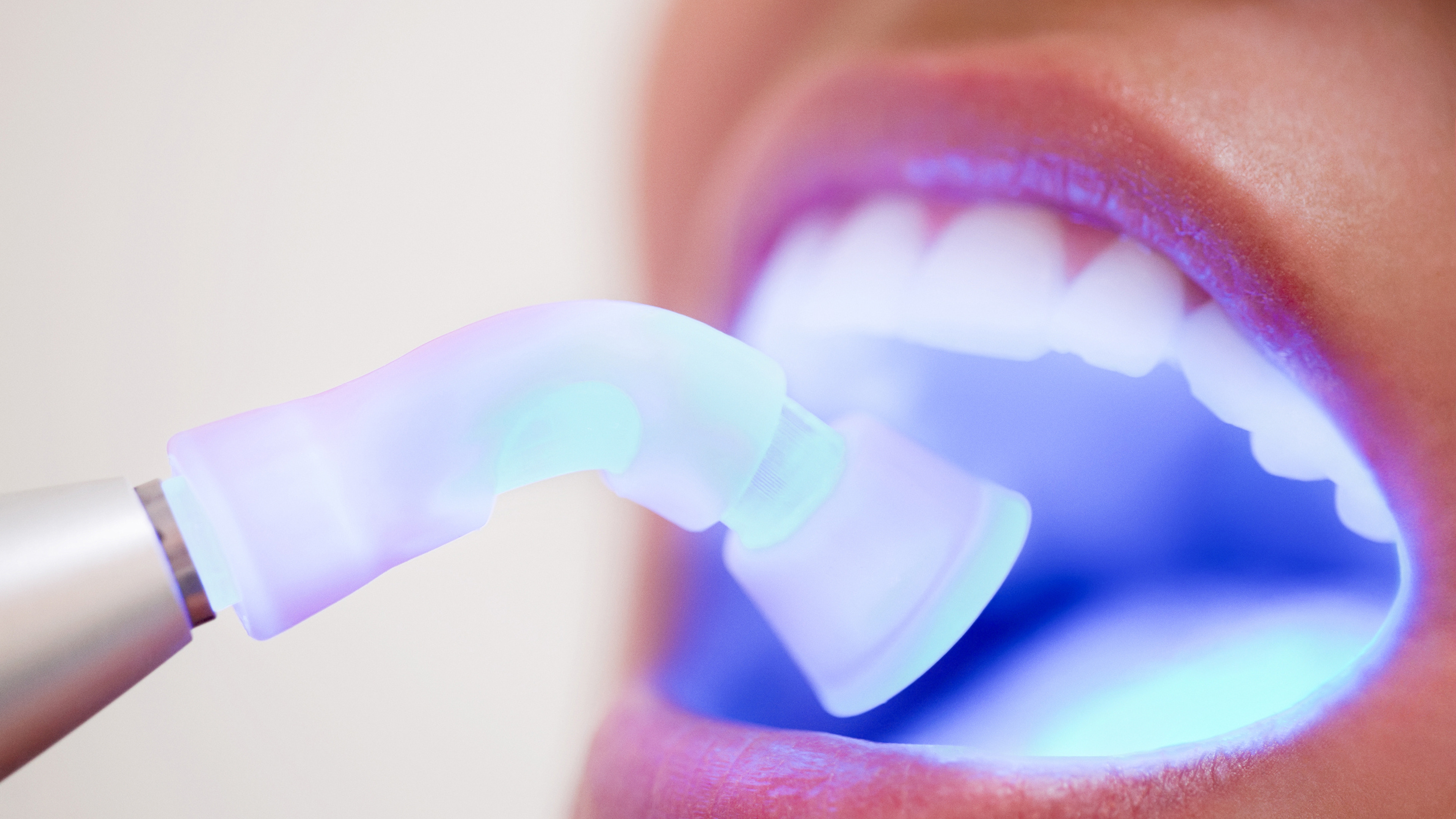 Dr. Nidhi Vyas performing dental bonding at The Dental Lounge in Indore, Madhya Pradesh, India, showcasing a patient's smile transformation with tooth-colored resin for a seamless repair of chips and gaps.