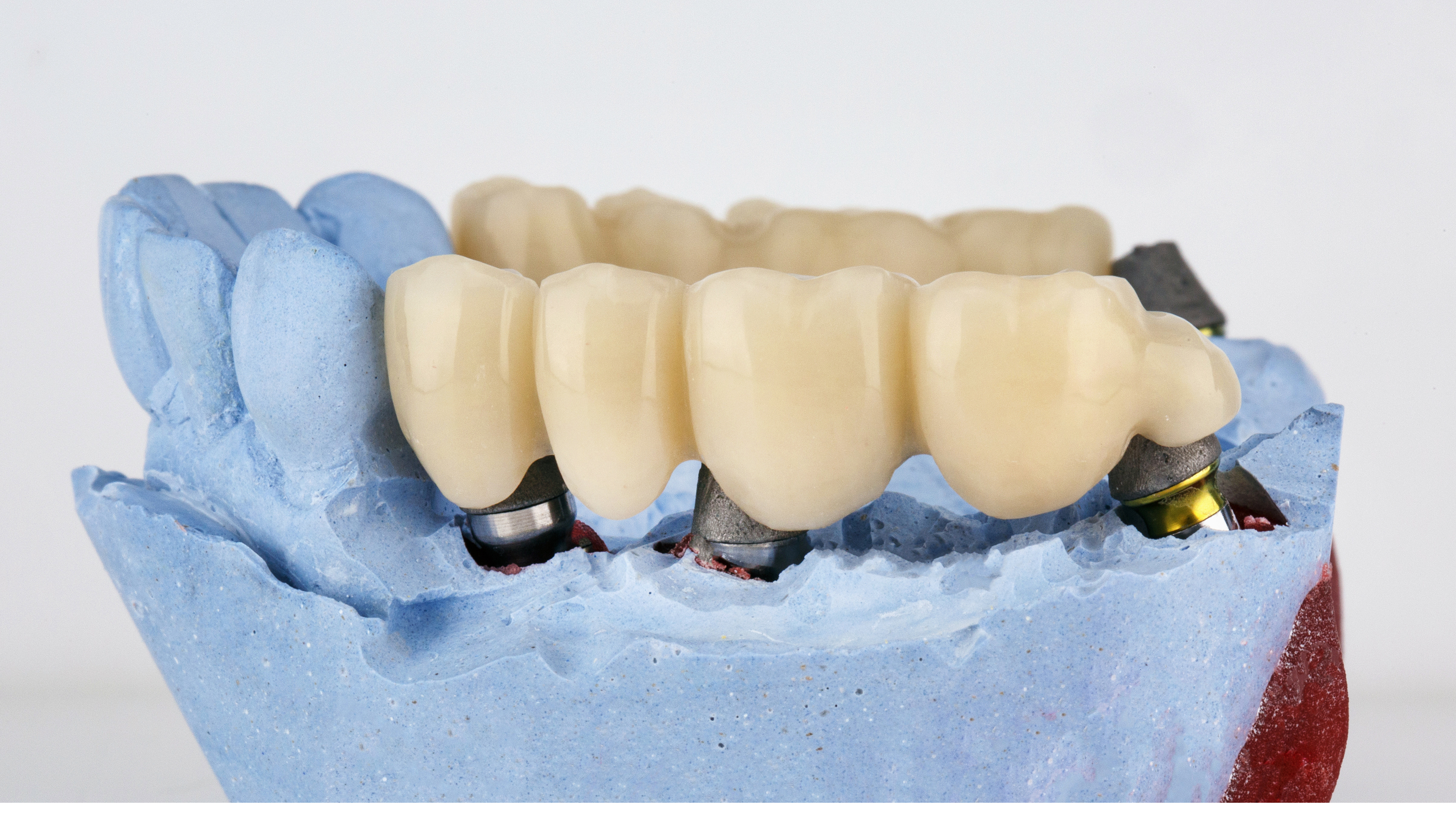 Dental bridges and dentures custom-designed by Dr. Nidhi Vyas at The Dental Lounge in Indore, Madhya Pradesh, India, offer a seamless solution for missing teeth, restoring smiles and functionality with precision craftsmanship.
