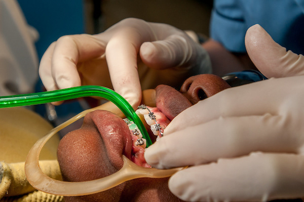 A young person having his brace adjusted
