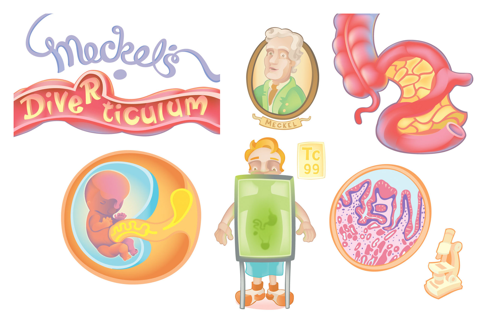 Meckel's Diverticulum Spots