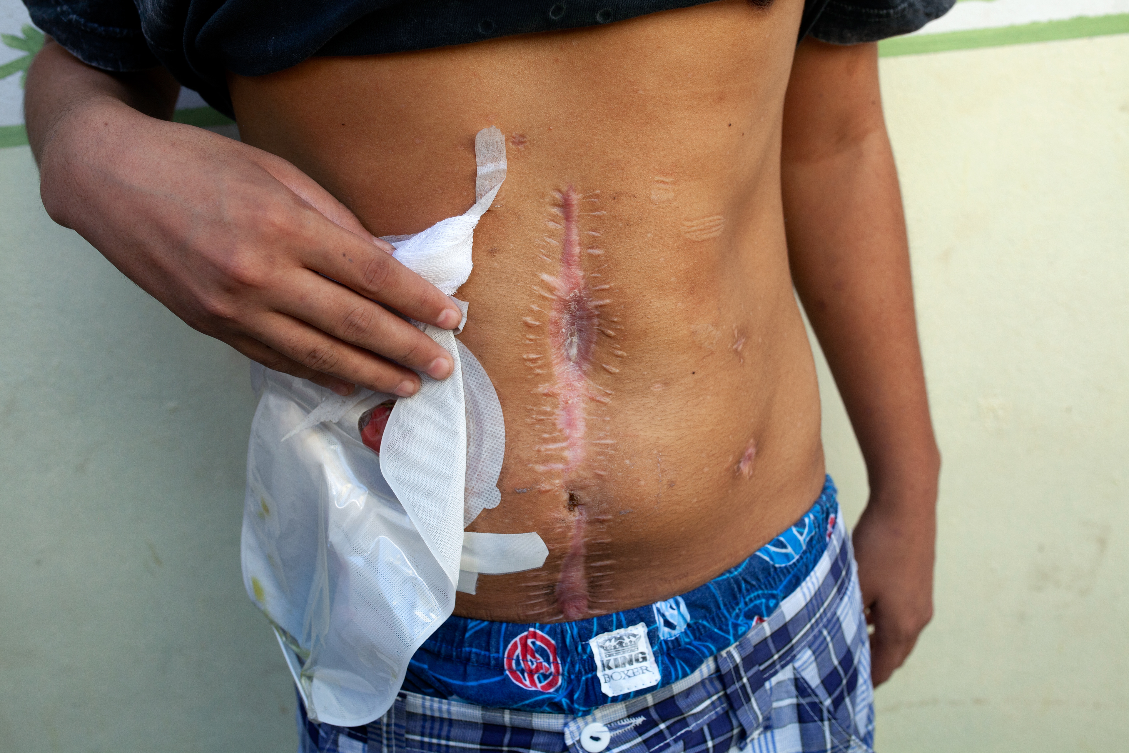 Un joven sobreviviente a la masacre de Apatzingán, ocurrida el 6 de enero de 2015, muestra las heridas en su cuerpo tras recibir varios impactos de bala disparados por la Policía Federal. Fotografía tomada en mayo de 2015. (foto: Prometeo Lucero / Fueron los Federales / Aristegui Noticias)