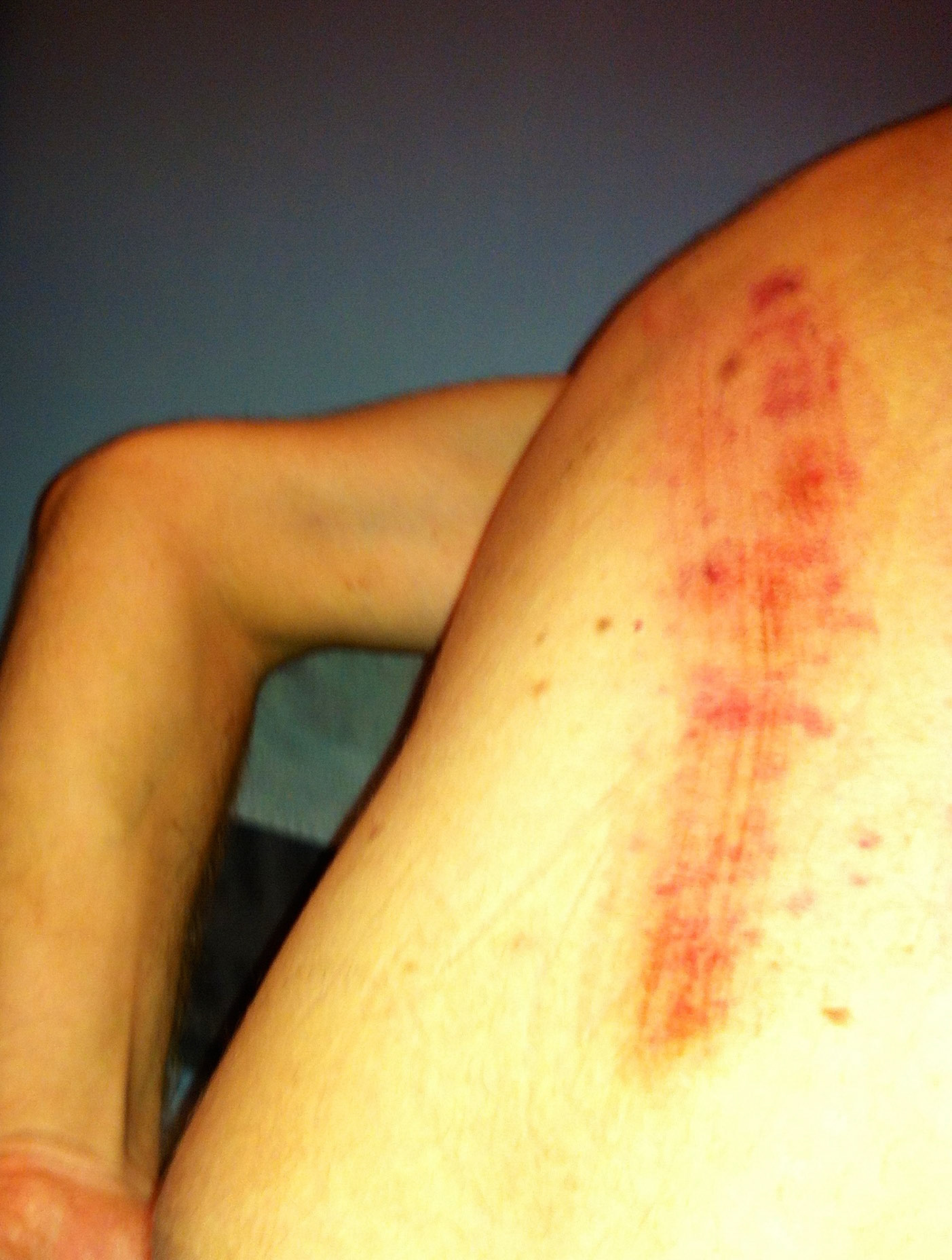 Tough Mudder damage on my back: this one wasn't supposed to happen - I knocked into a piece of wood when falling from the rings. Really thankful it wasn't worse: and it's healing up well… and yes I'll do Tough Mudder again!