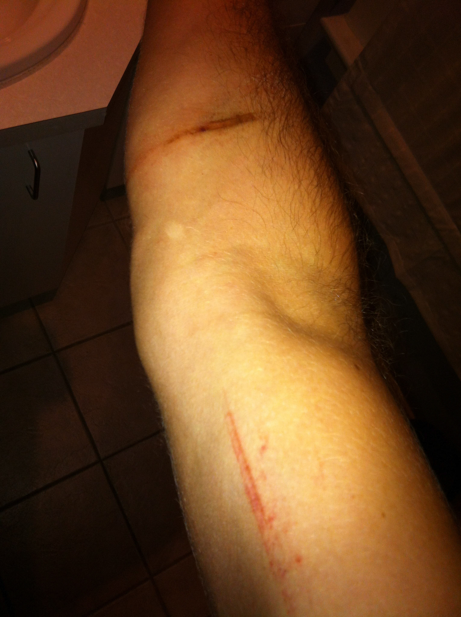 Tough Mudder damage: my arm