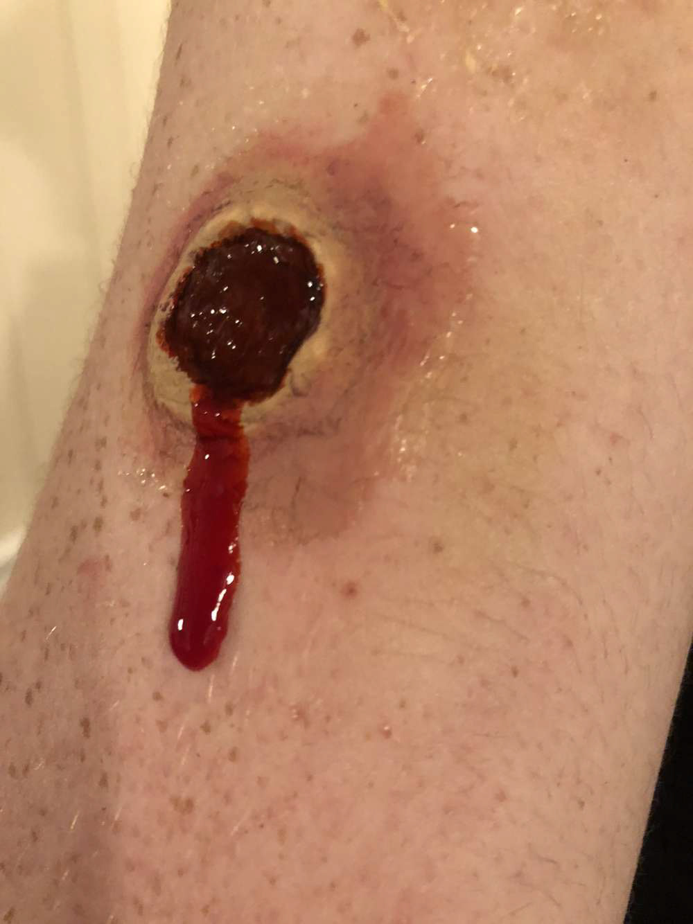 Bullet Wound
