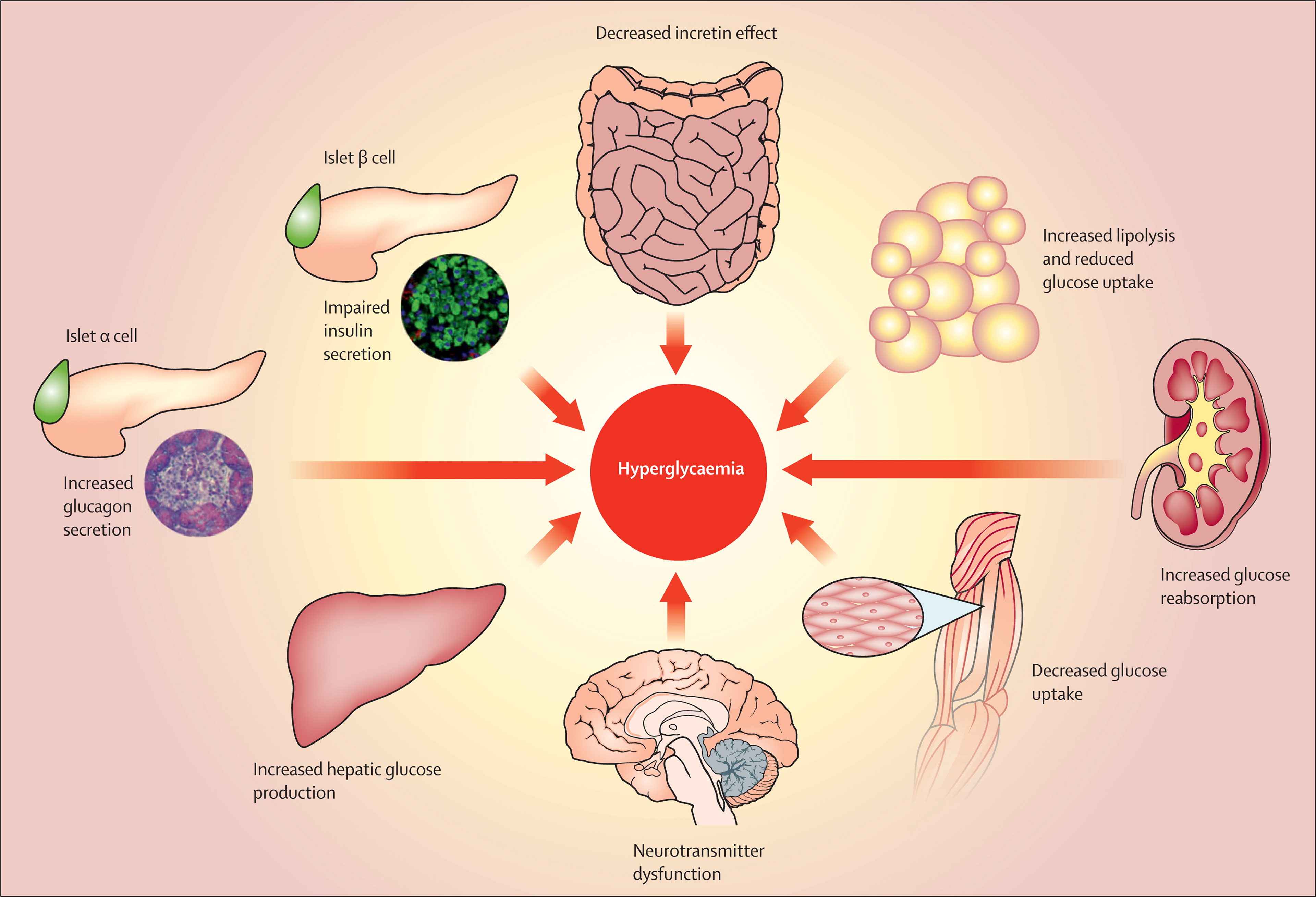 presentation of type 2 diabetes mellitus