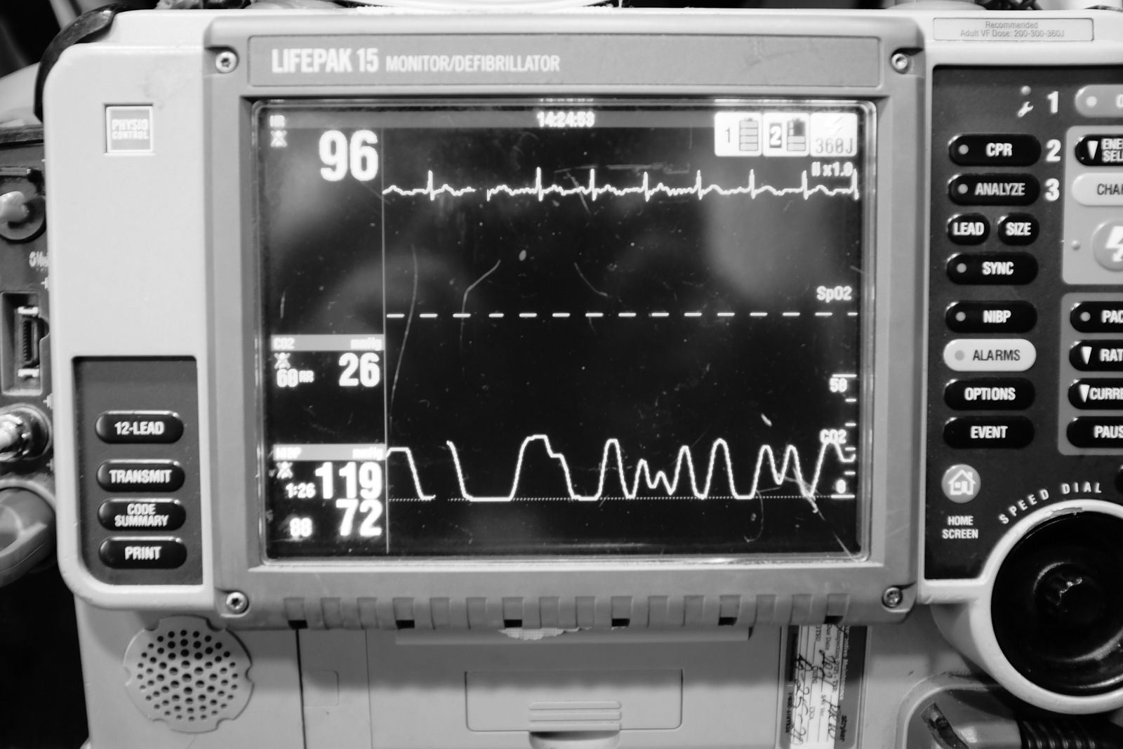 New gadget, first-time using nasal capnography.