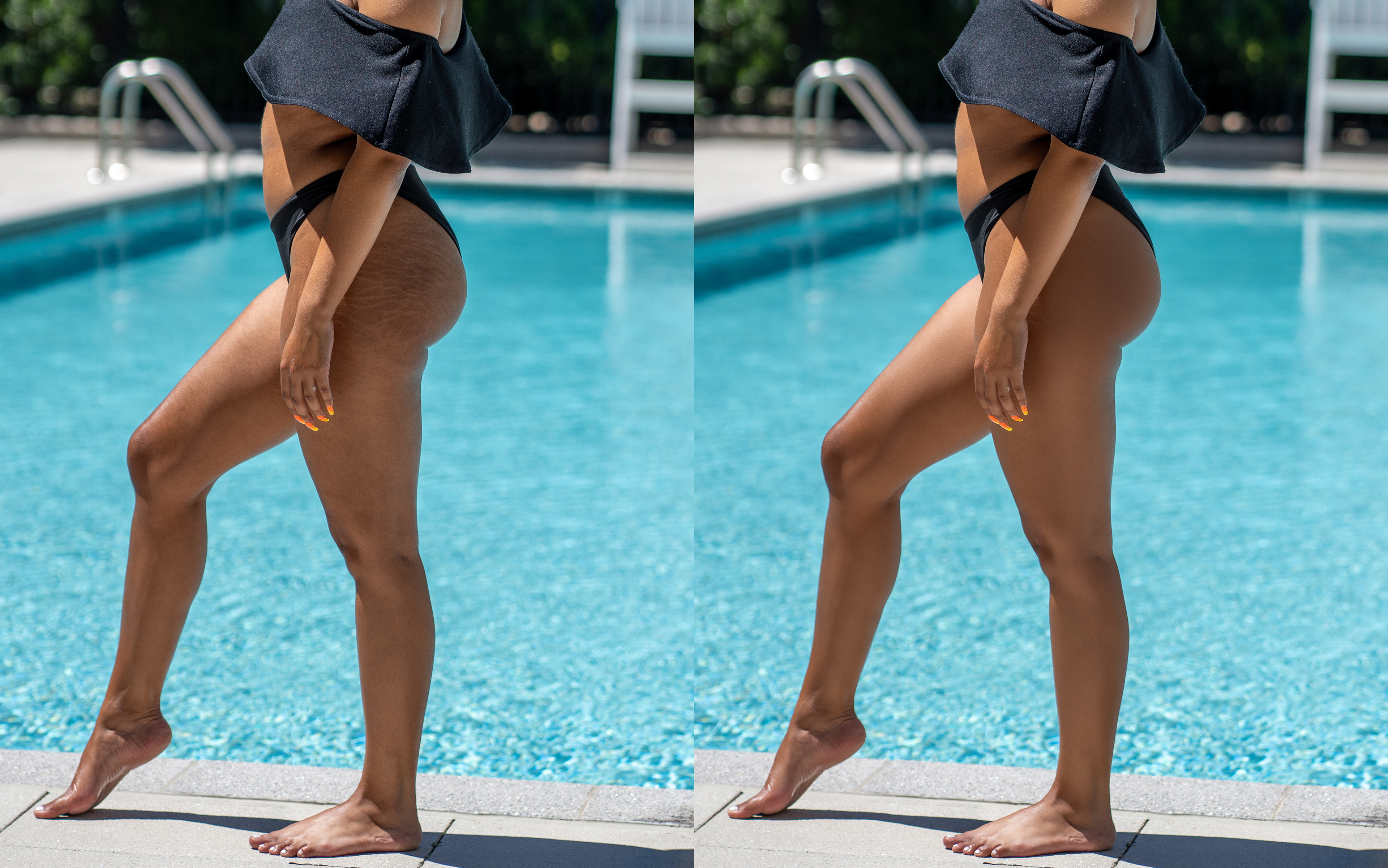 Stretch Mark Removal/Reduction