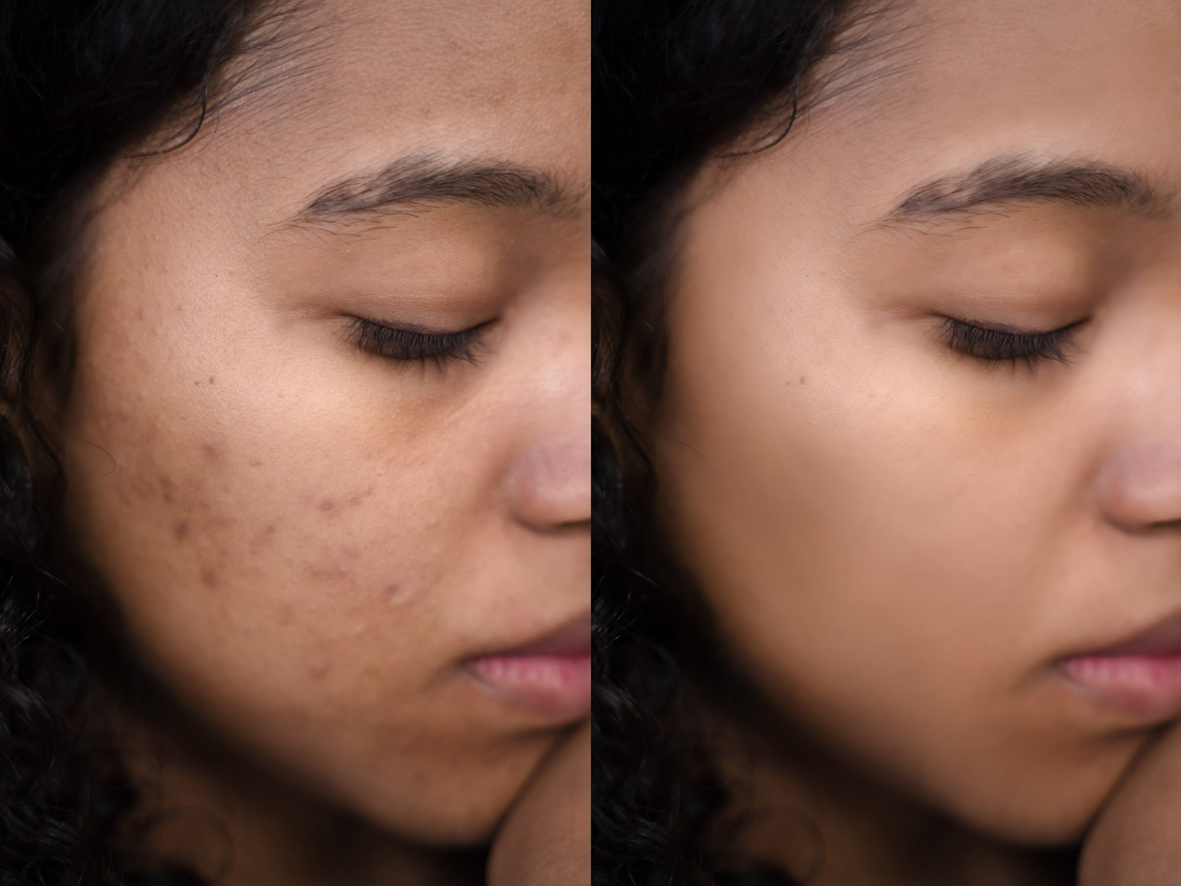 Acne cleanup