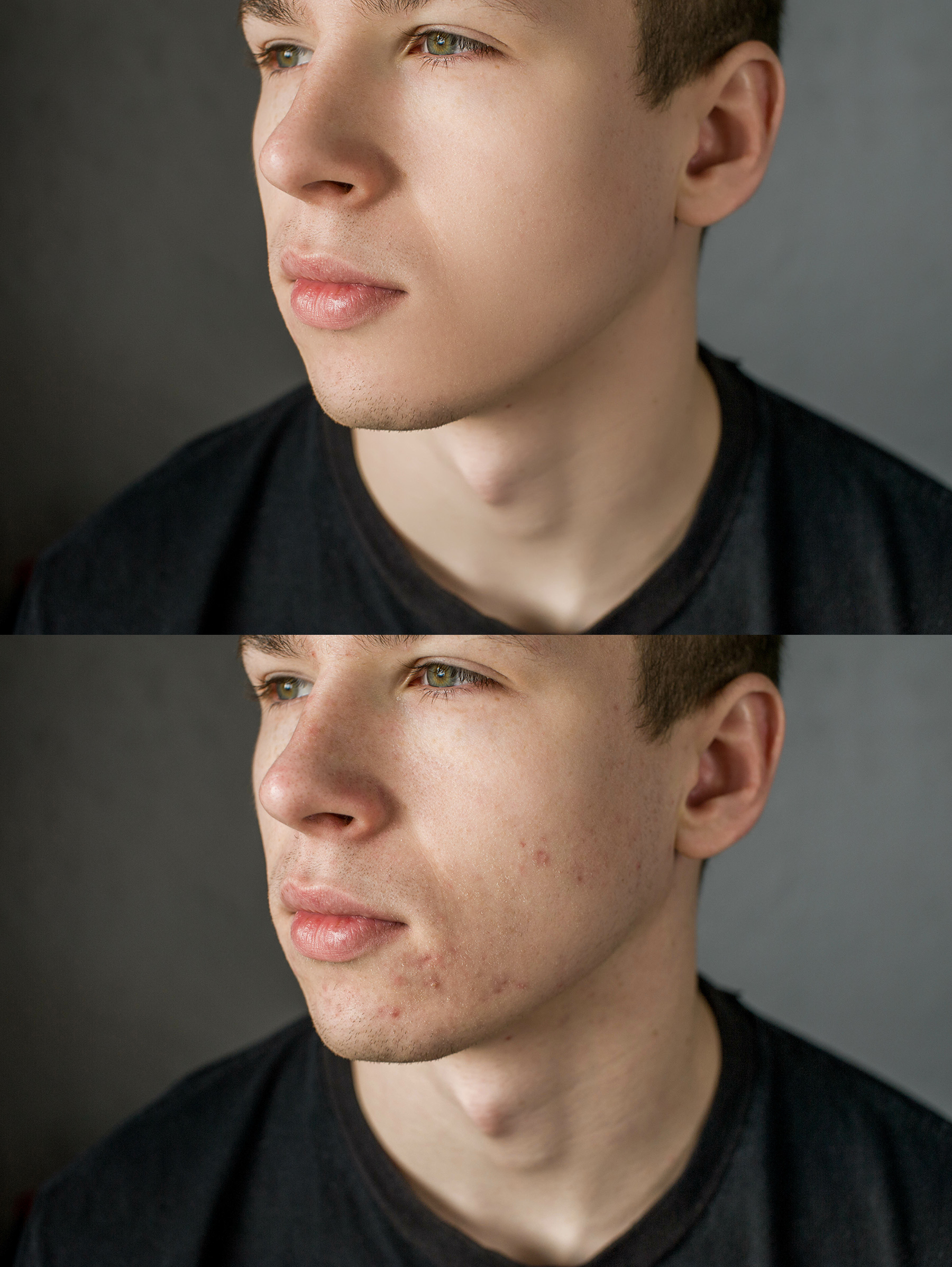 Blemish removal