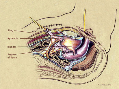 Ileocystoplasty with pubovaginal sling final cross section