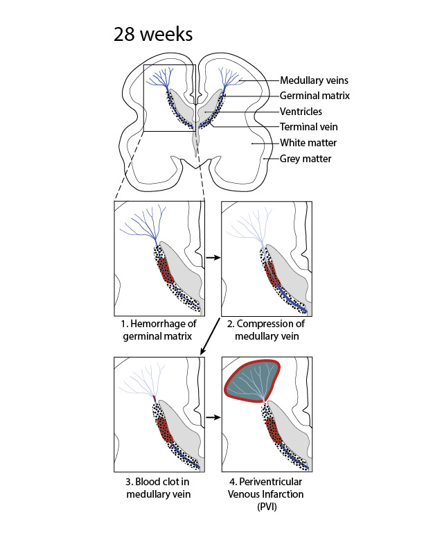 In PVI, the germinal matrix hemorrhage leads to such an impairment of blood drainage from the periventircular white matter that it becomes injured or infarcted (i.e. a stroke)