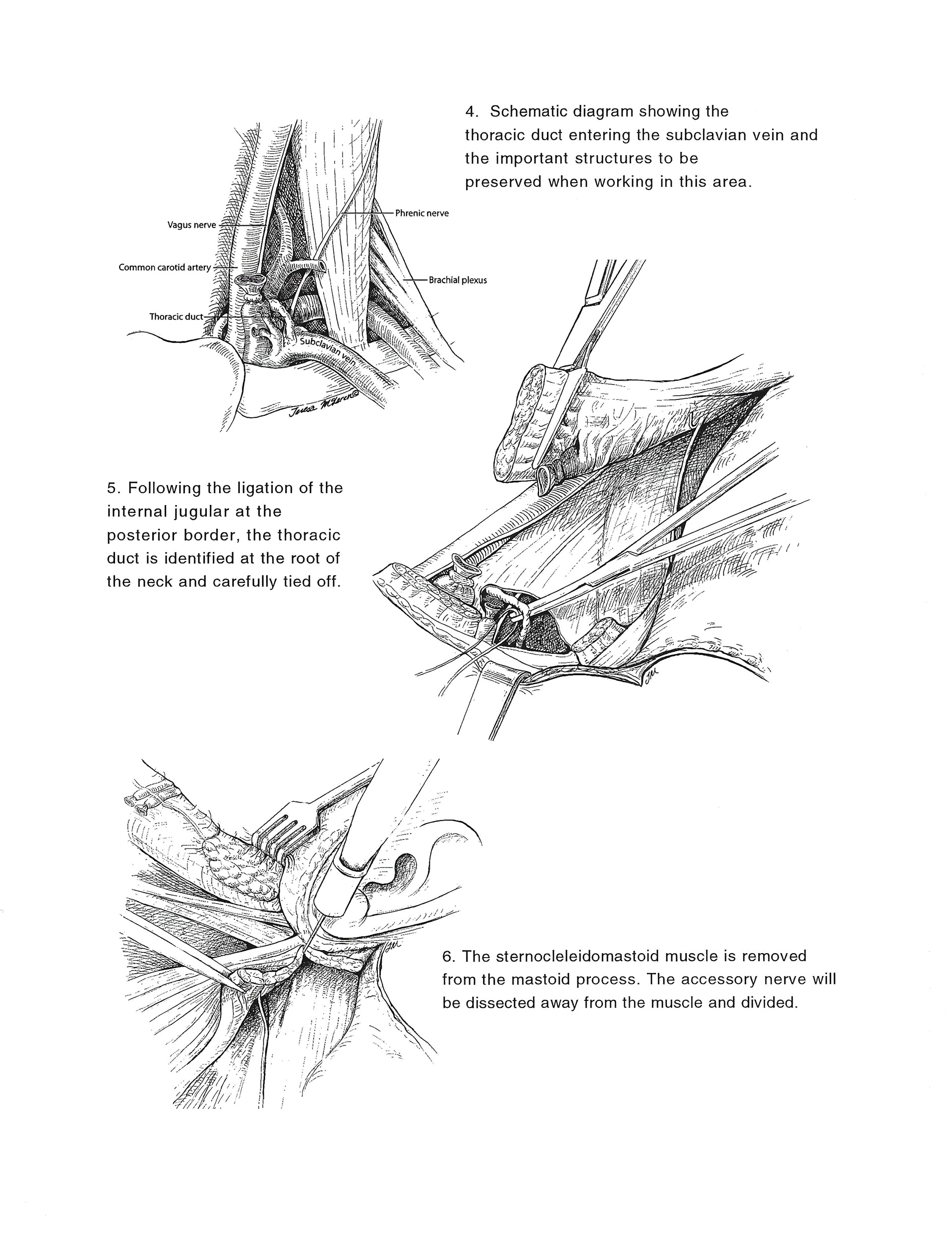 Radical Neck Dissection in Ink
