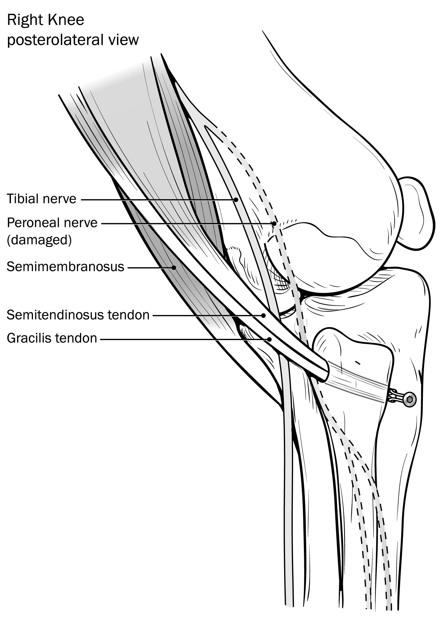Surgical Illustration Line: Lateral depiction of the tendons that were transferred through the fibular head and fixed to the anterolateral aspect of the tibia.