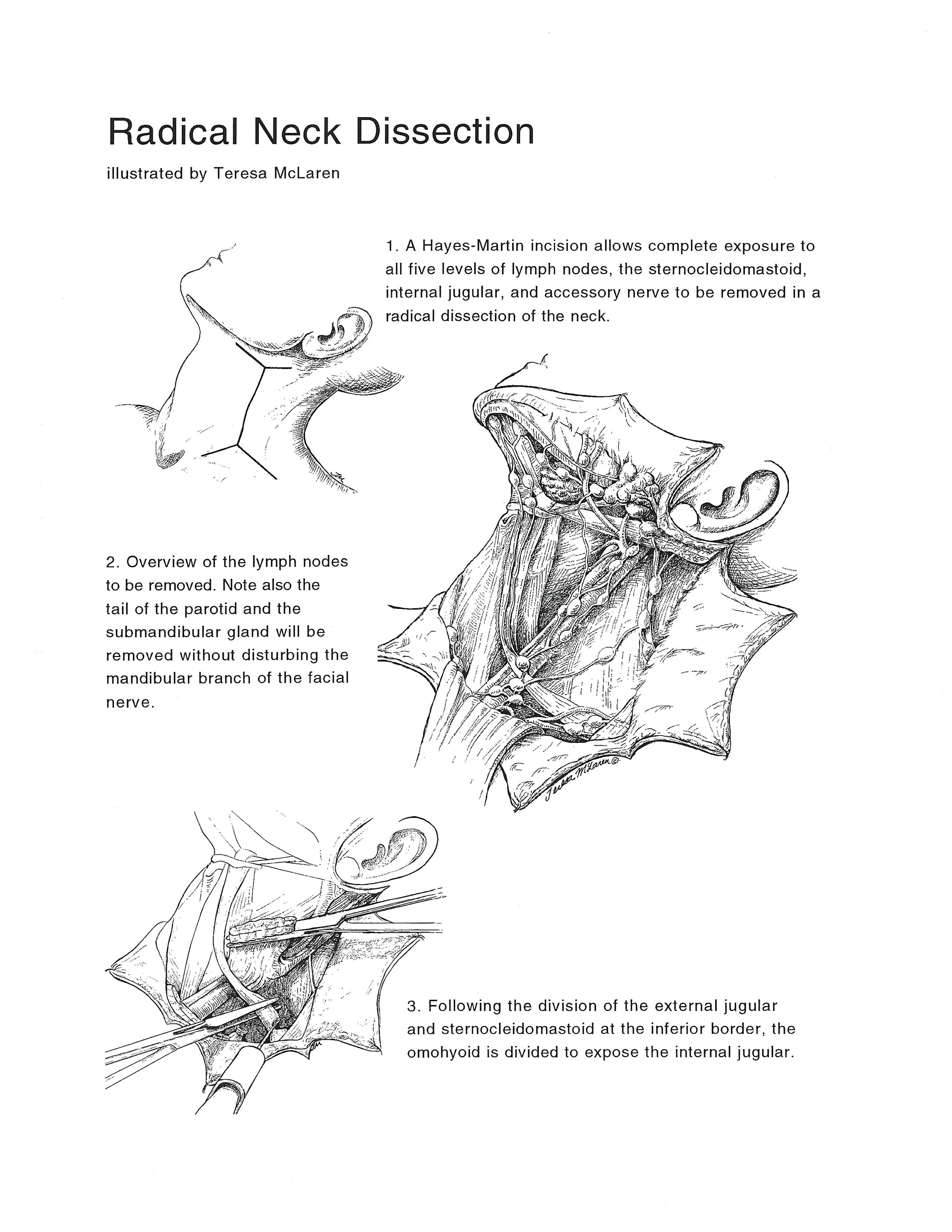 Radical Neck Dissection in Ink