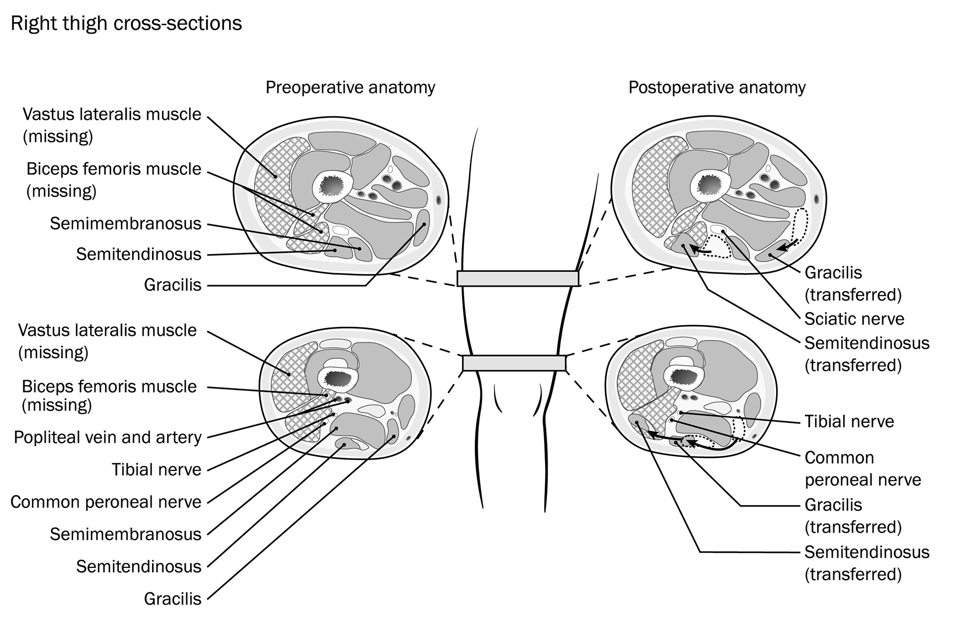Cross-sectional anatomy sections of the distal aspect of the right thigh, showing the subcutaneous nature of the laterally transferred semitendinosus and gracilis tendons, which were used to replace the biceps femoris, and their relationship to the major nerves and vessels.