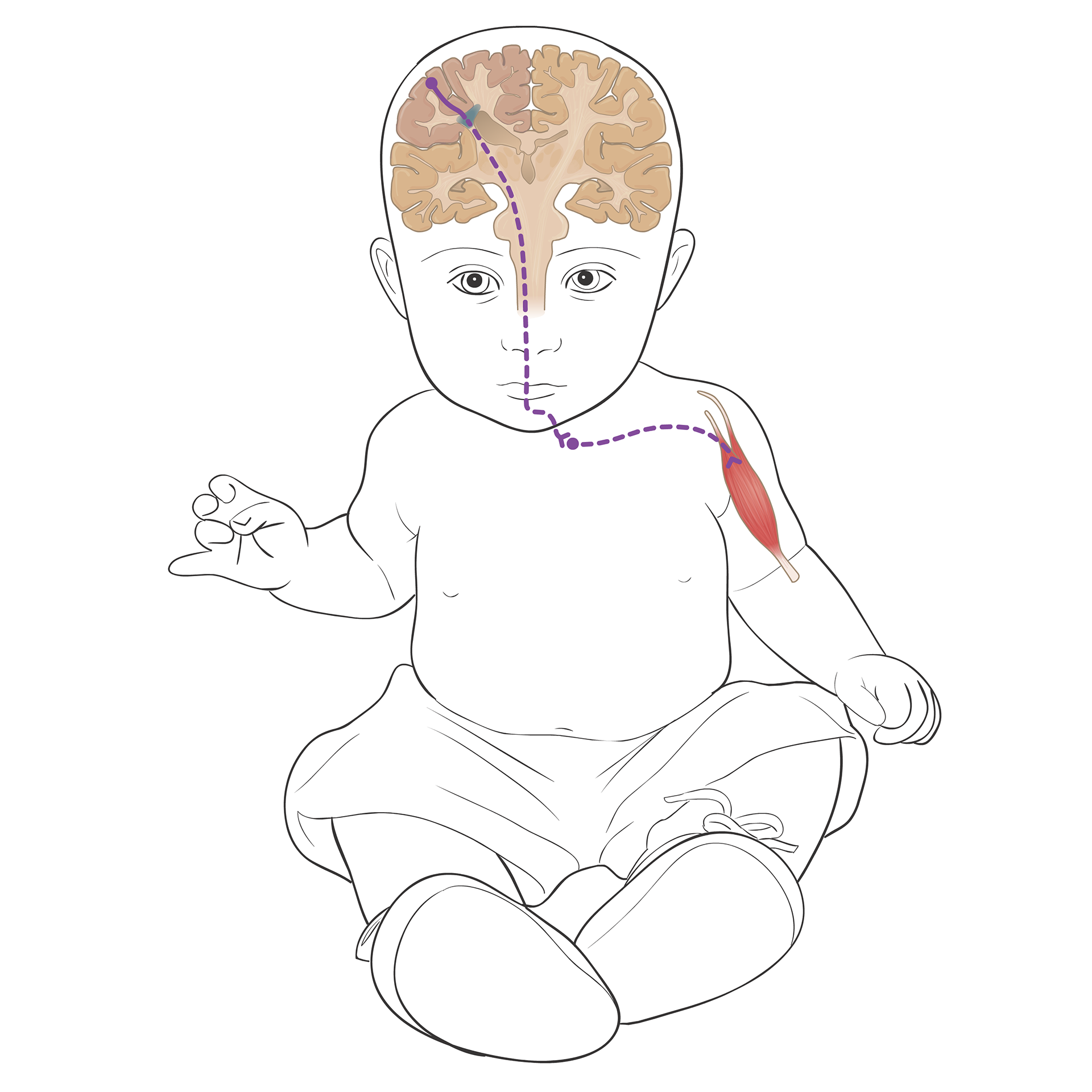 PVI damages pathways - weakness on opposite side