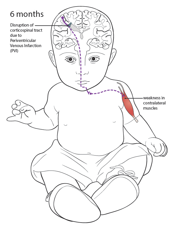 Disruption of corticospinal tract due to PVI causes weakness in the contralateral muscles