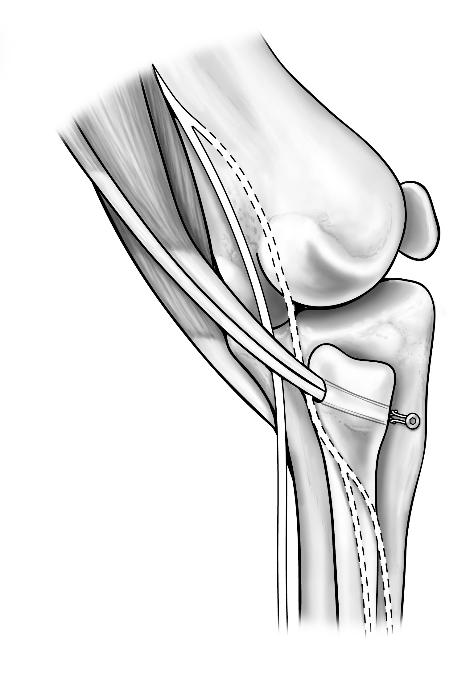 Surgical illustration tone