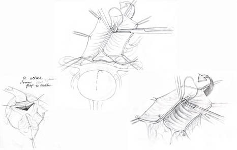Ileocystoplasty preliminary drawings