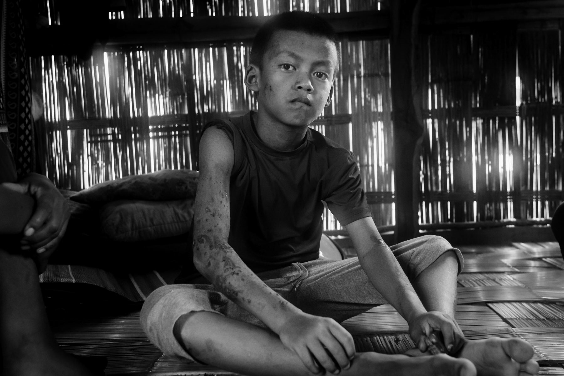 Chin refugee living in a refugee camp in Mizoram and victim of an accute infection and rash. He arrived from Matopi in Chin State in Myanmar in January 2022. Mizoram, India, October 2022