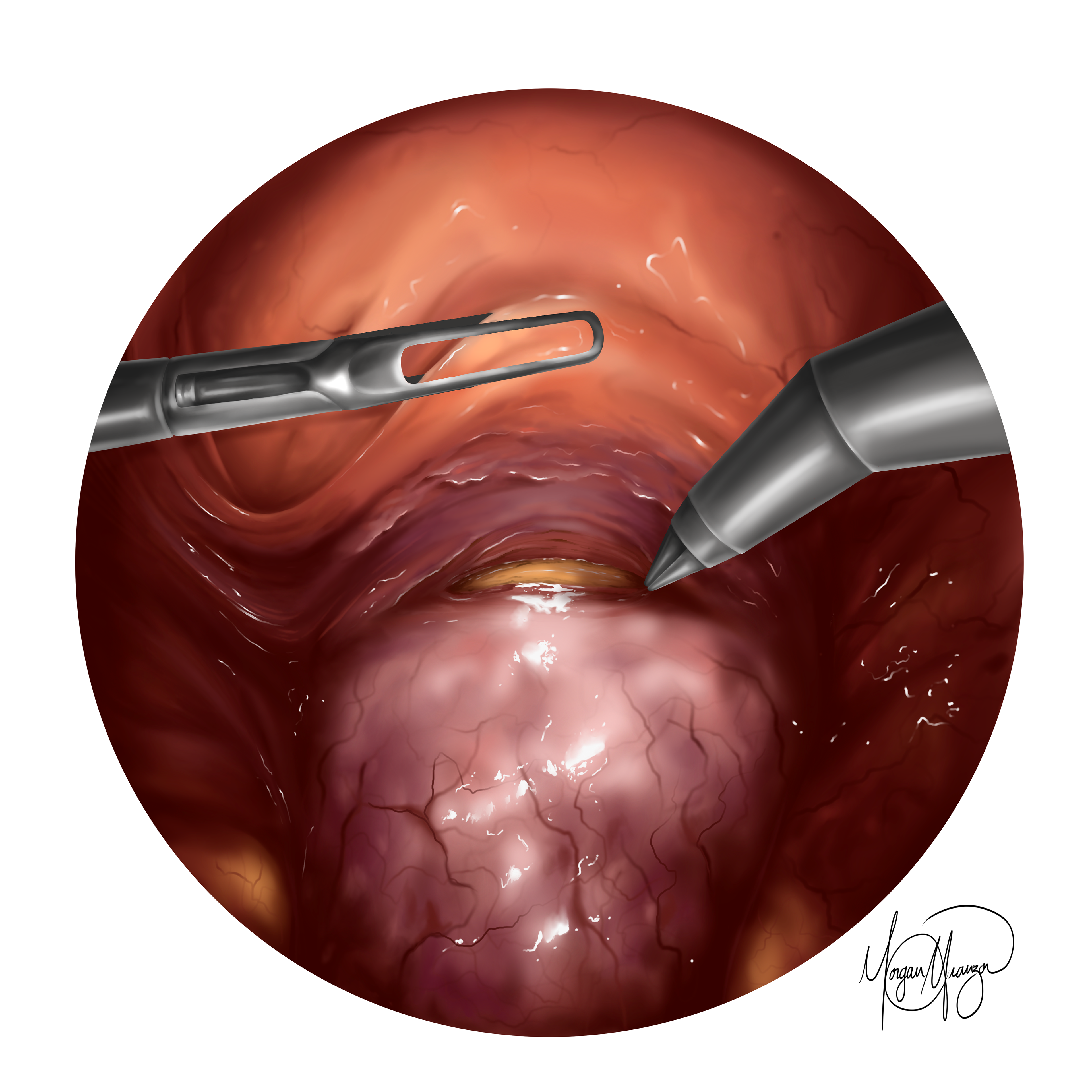 Total Laparoscopic Hysterectomy. d (Procreate, 2026)