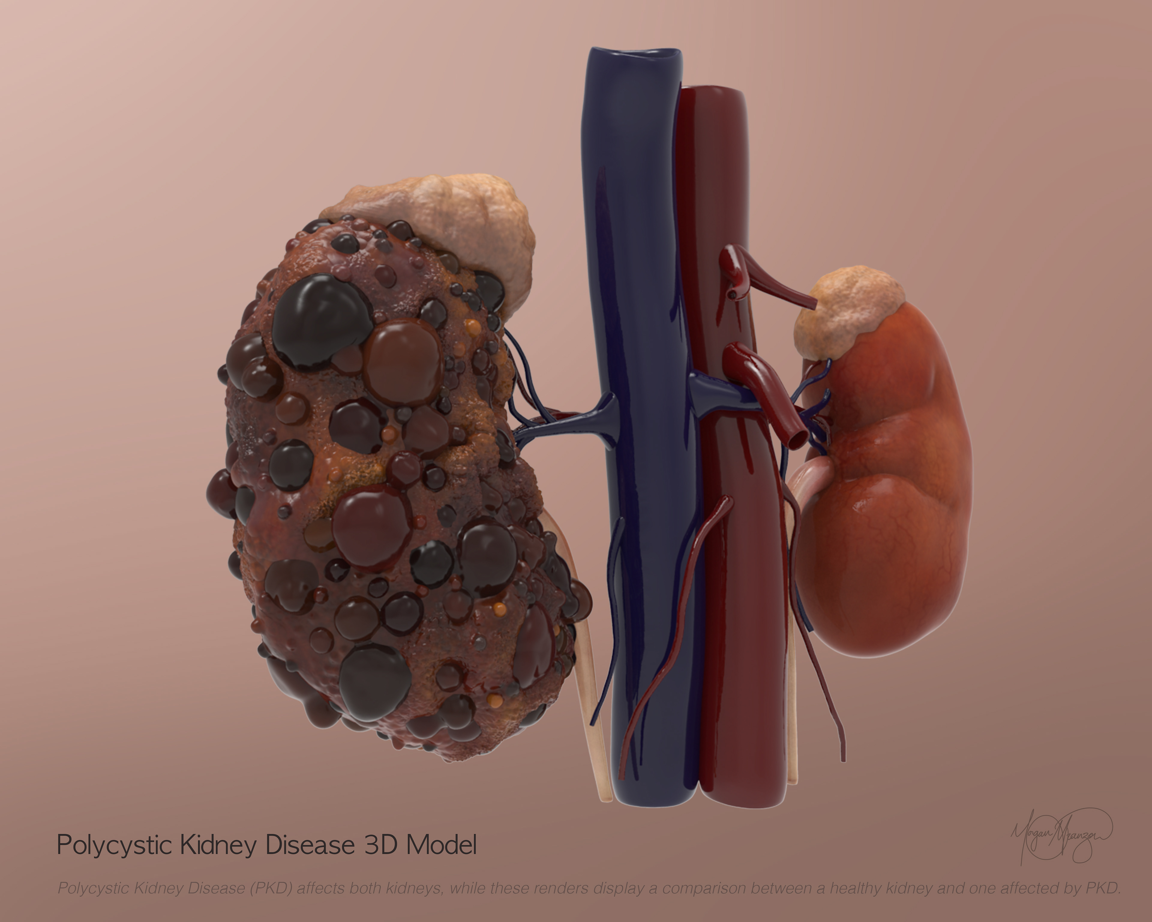 Polycystic Kidney 3D Modle (ZBrush, 2026)