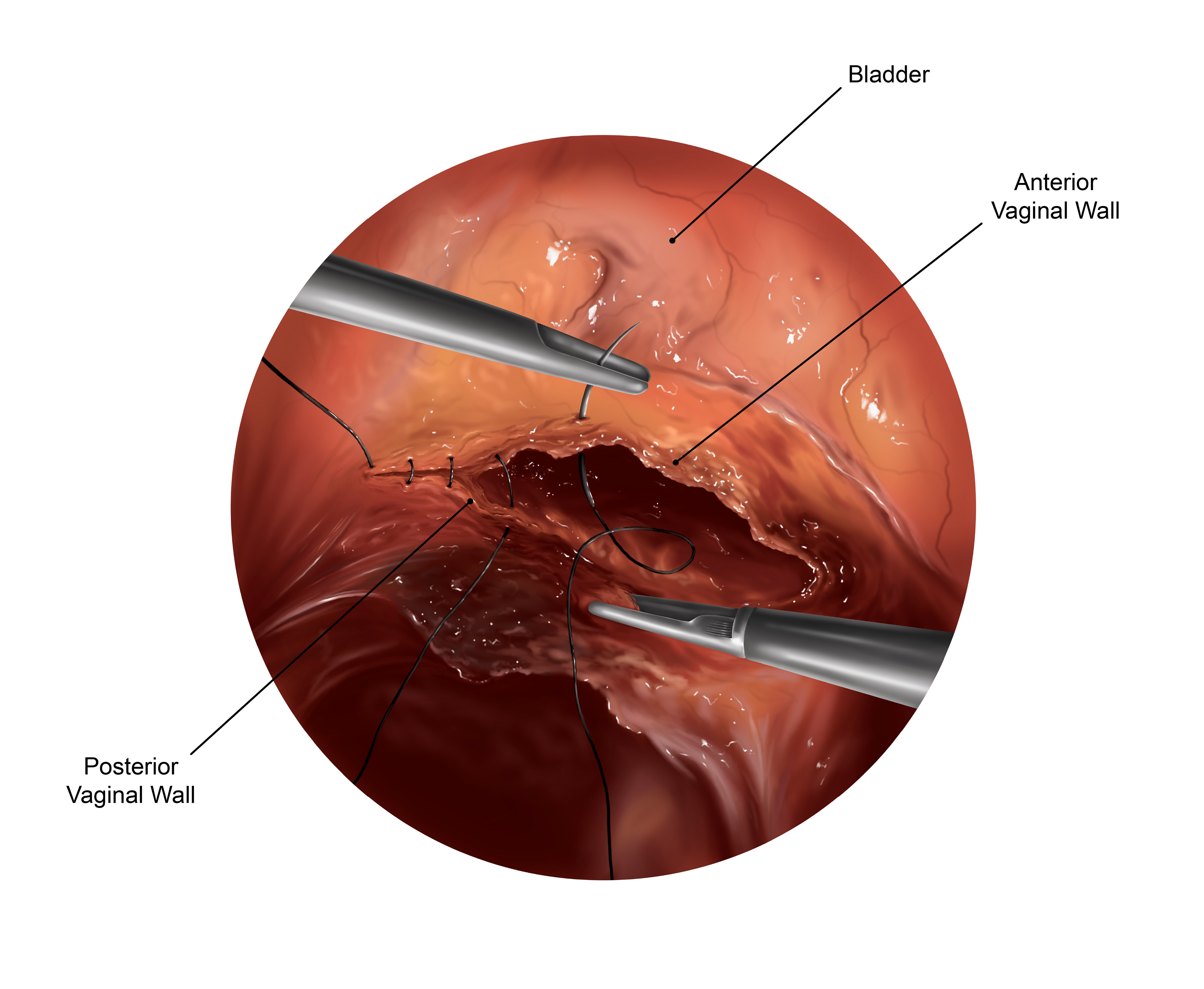 Total Laparoscopic Hysterectomy. e (Procreate, 2026)