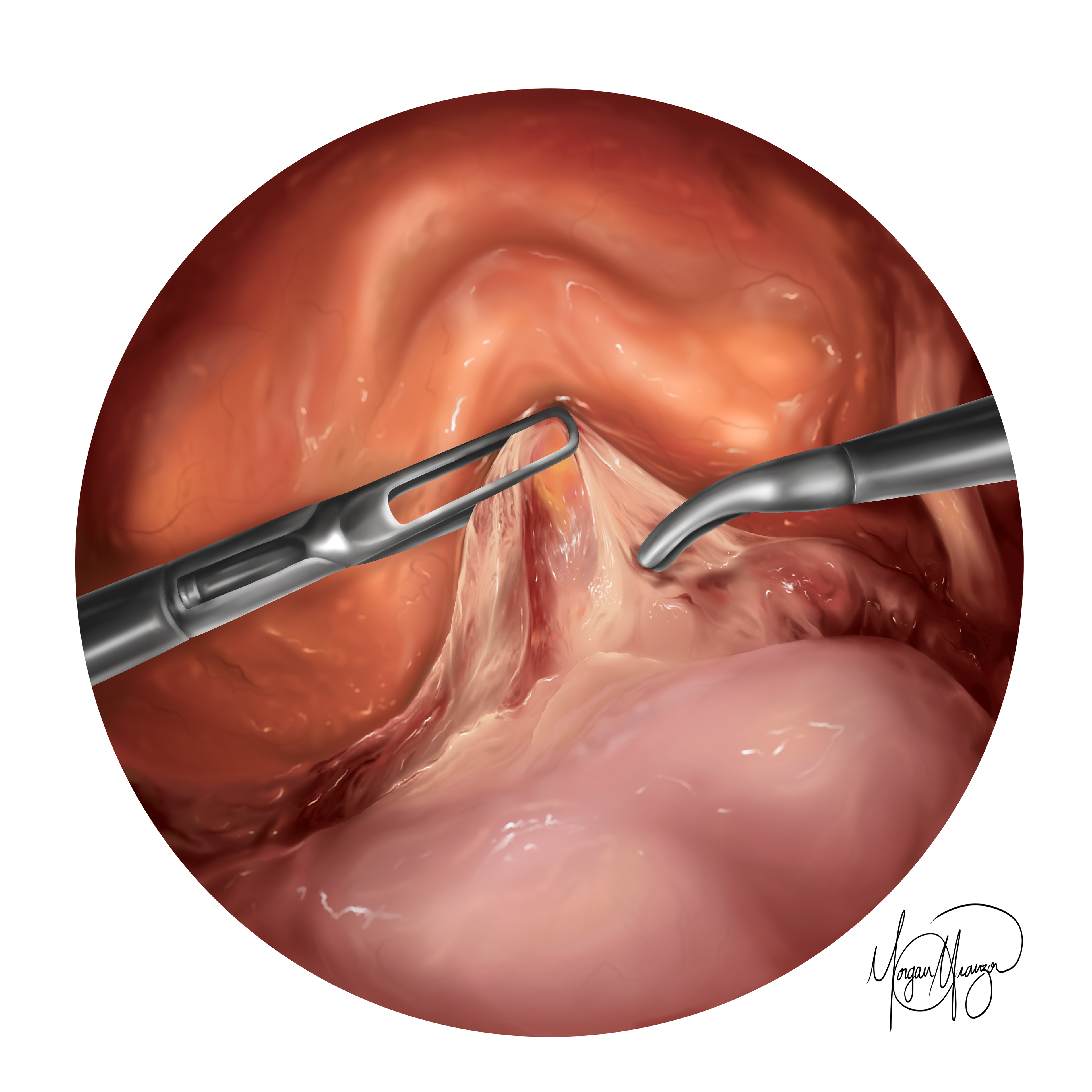Total Laparoscopic Hysterectomy. b (Procreate, 2026)