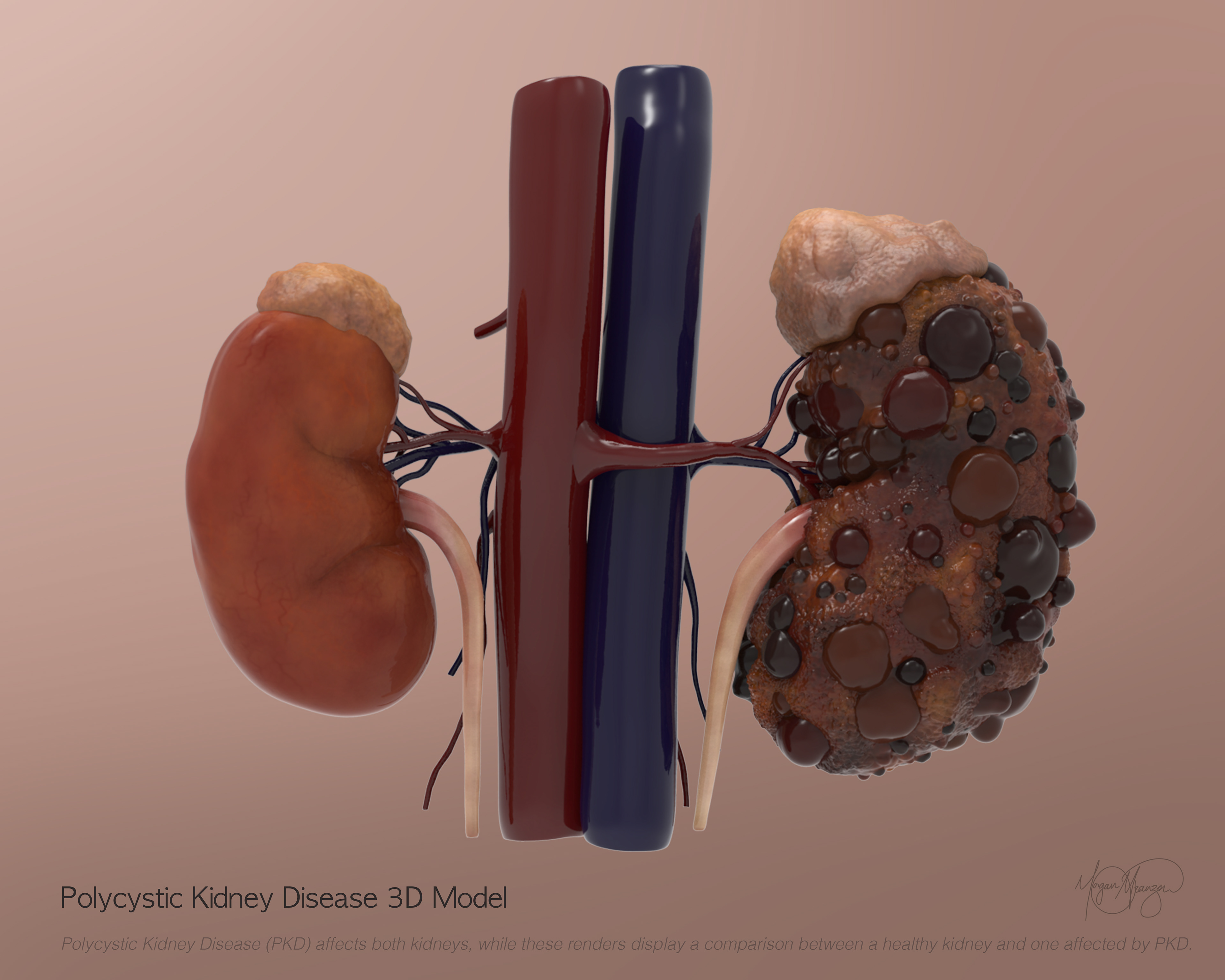Polycystic Kidney Disease Model (ZBrush, 2026)