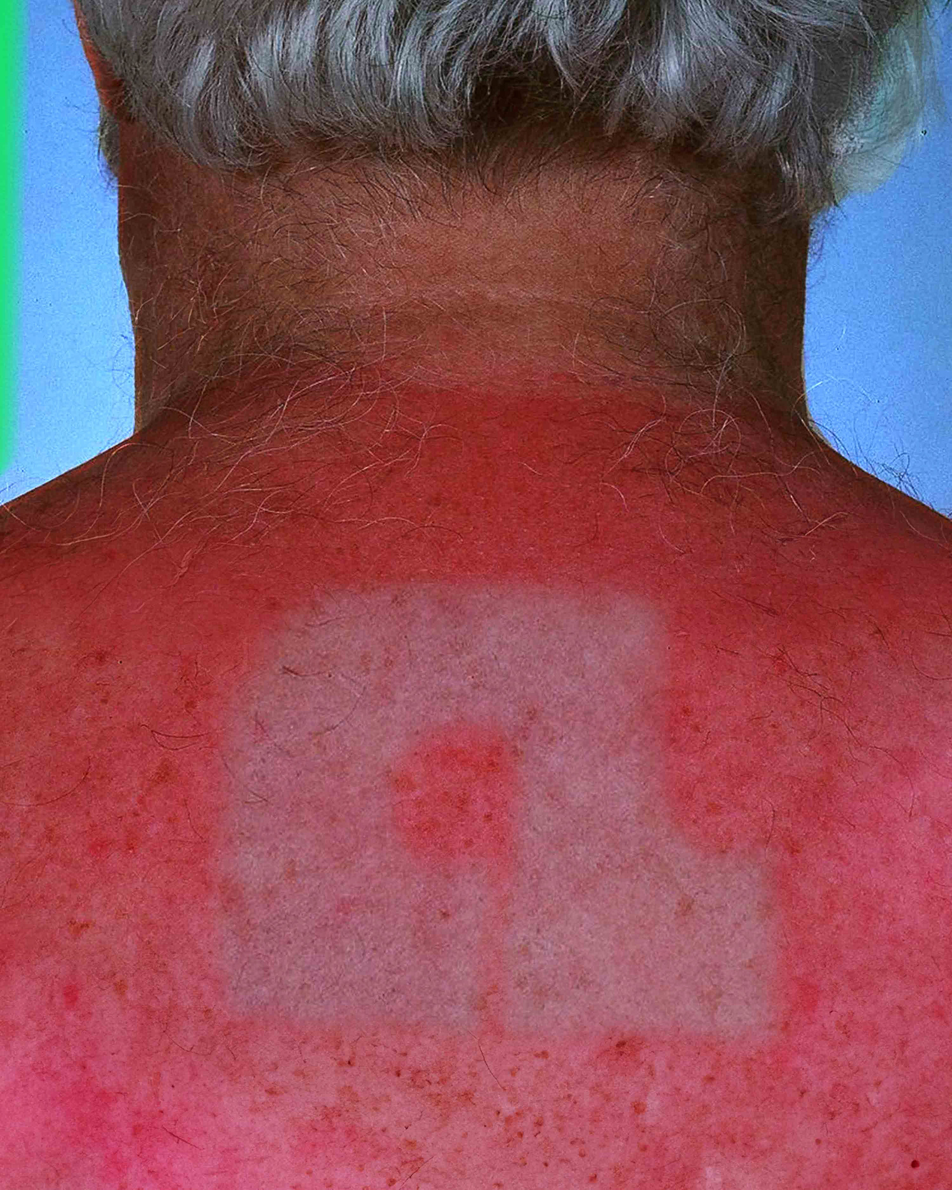 Anotherland Sunburn