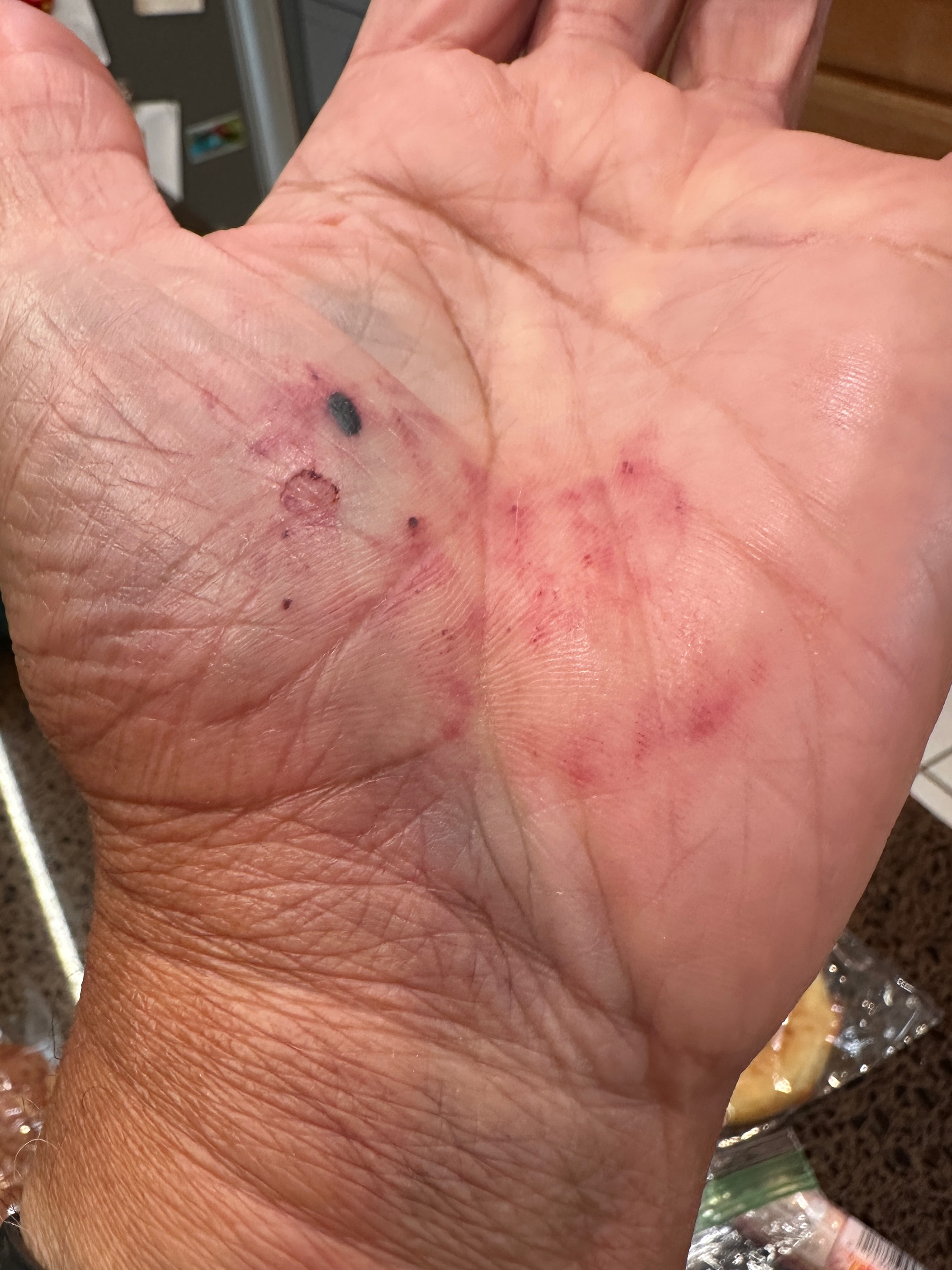 This wrist is broken (at mile 9)