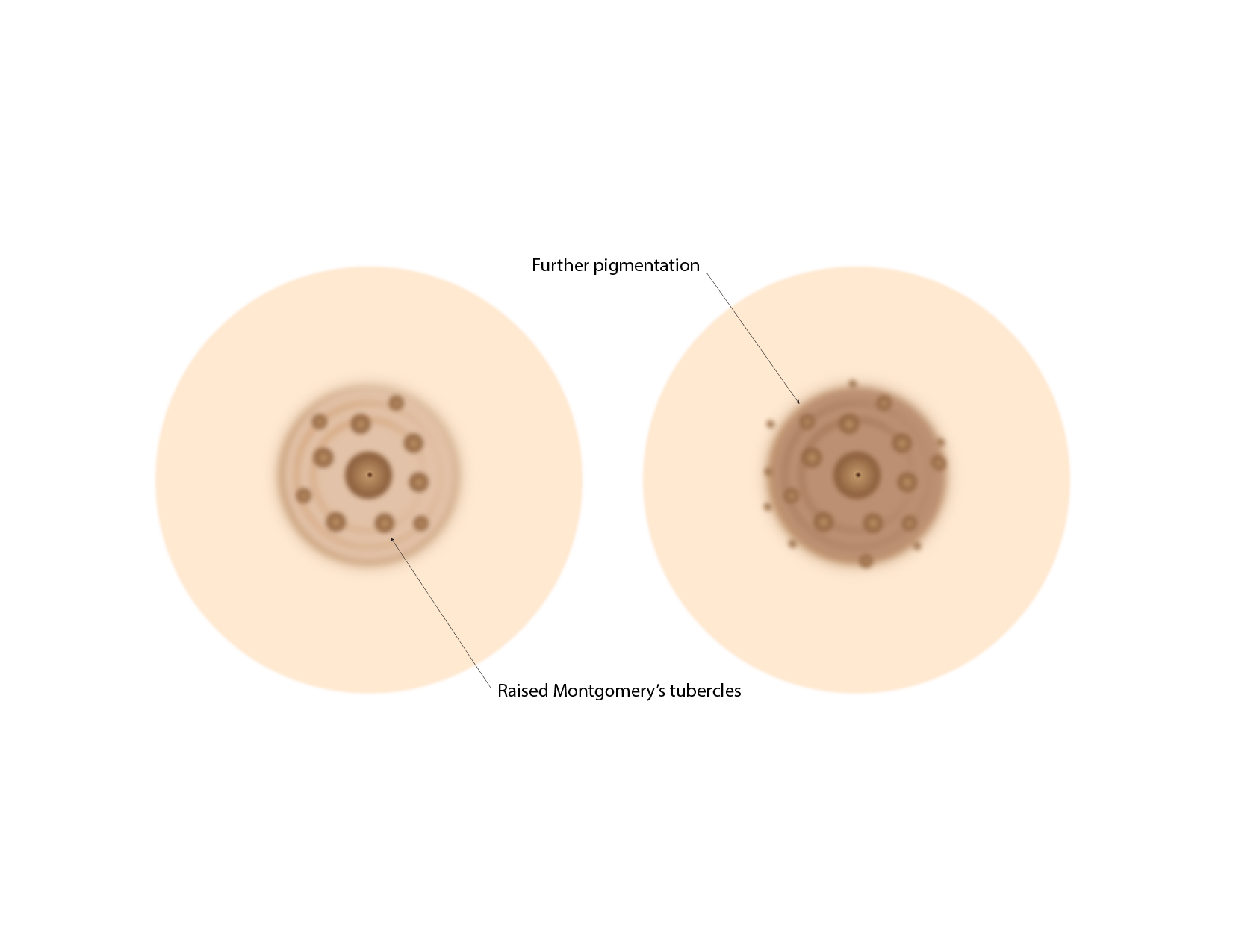 Montgomery tubercles