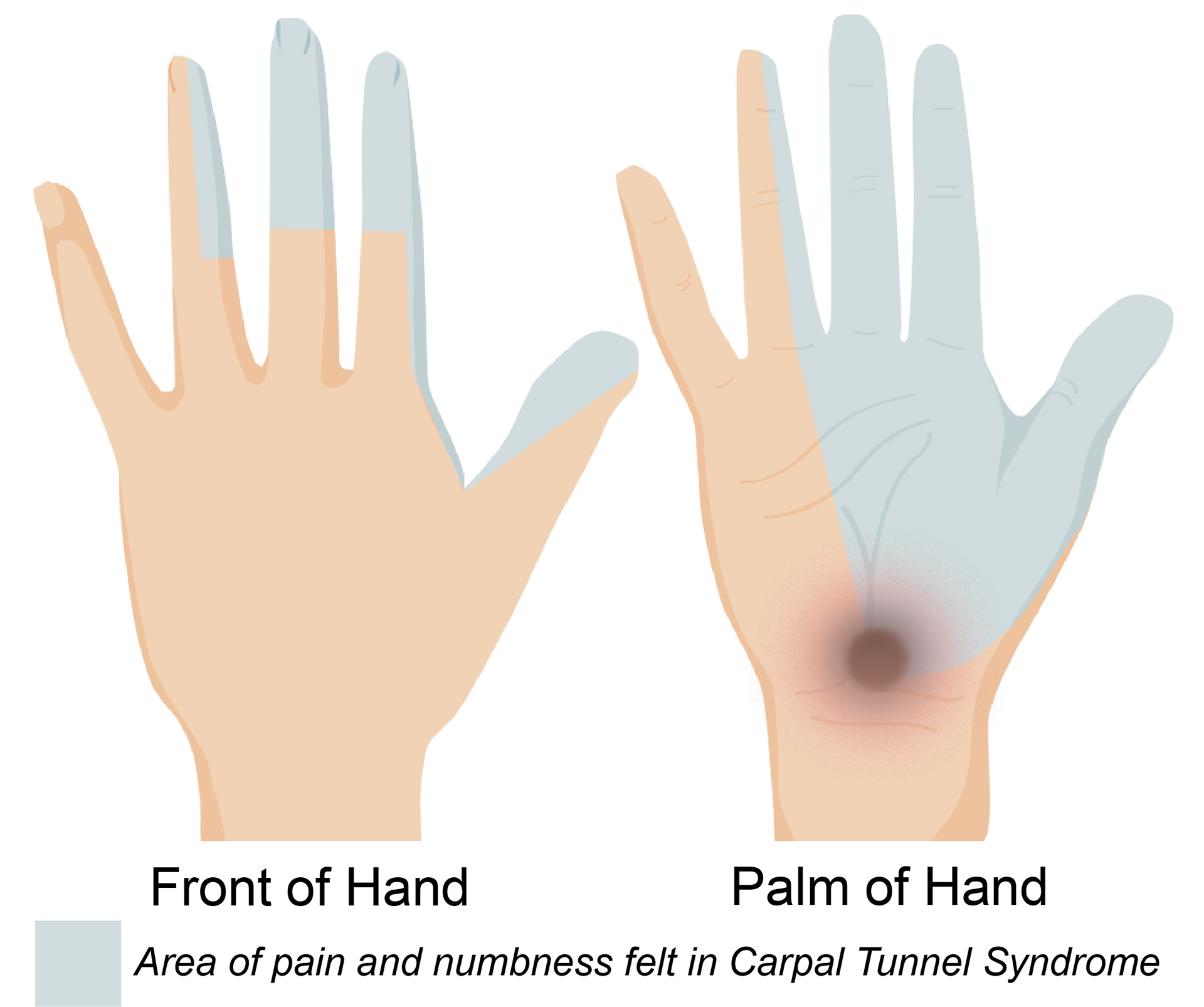 Carpal Tunnel Syndrome
